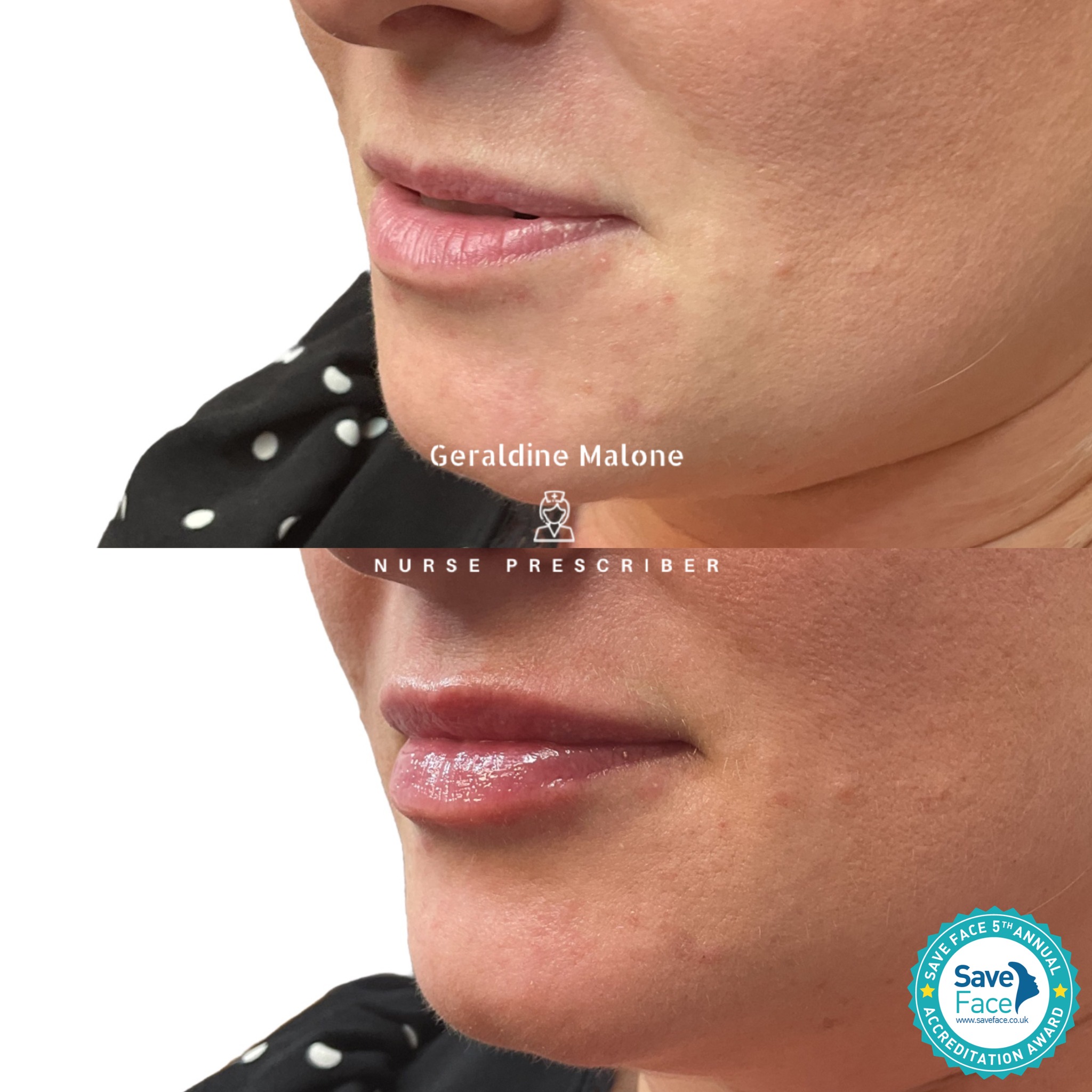 0.5ml Lip Enhancement 👄
Subtle, balanced, and natural-looking lip enhancement ✨
This treatment was tailored to enhance shape, improve symmetry, and add soft volume while maintaining the client’s natural features.
⏱ Recovery: 24–48 hours
⏳ Results: 6–12 months
✔️ No edited images
✔️ Performed by Nurse Prescriber Geraldine Malone
✔️ Save Face Registered Clinic
📅 Book now:
https://www.geraldinemalone.co.uk/book-appointment
📞 024 7792 1812
📧 geraldinemaloneaesthetics@outlook.com