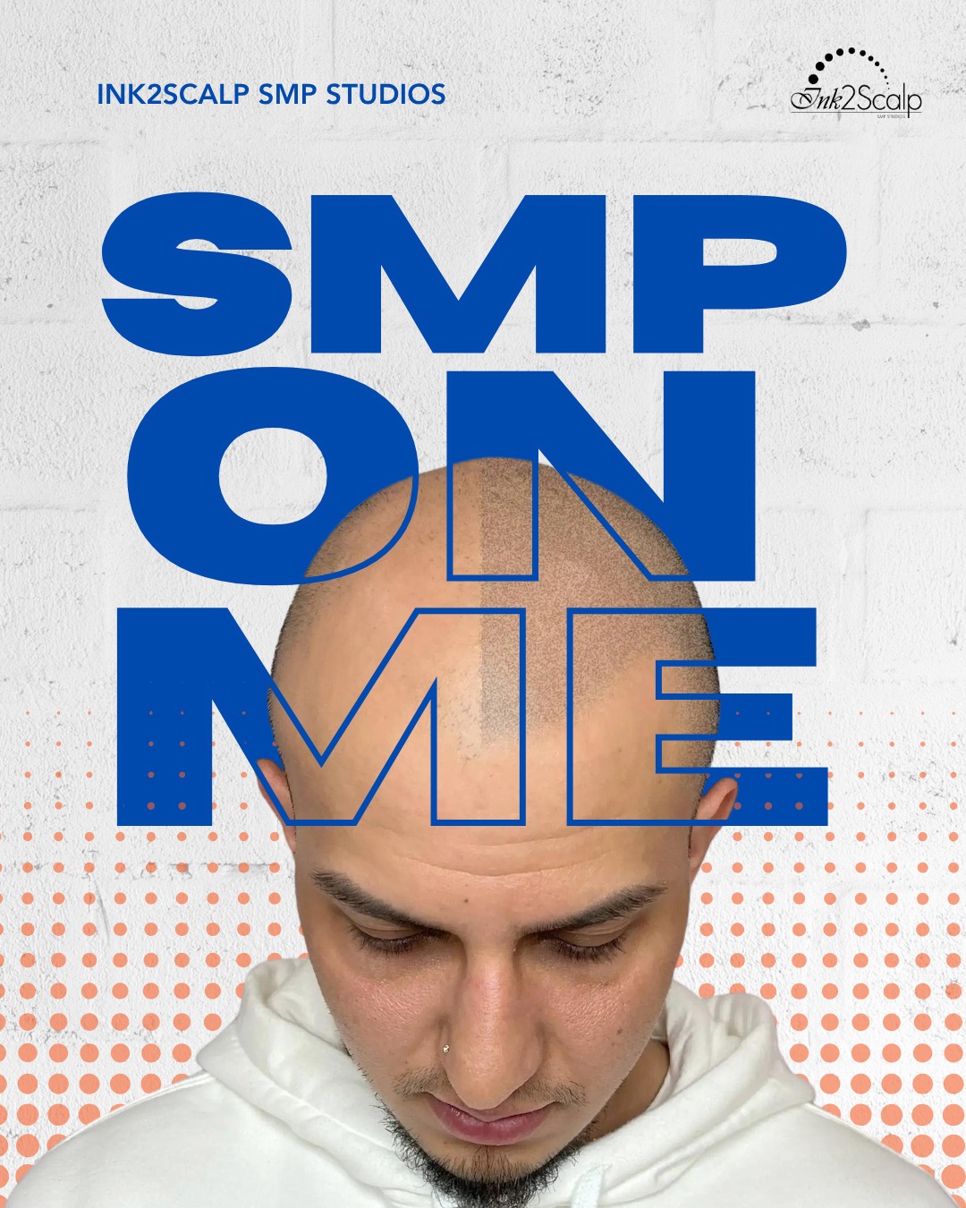 SMP ON ME: Experience the power of a perfect hairline! 🎯🔥
Look at this incredible split view showing the precise artistry of Scalp Micropigmentation in action. This specialized technique recreates the appearance of natural, dense hair follicles with absolute perfection.
Seeing the transformation halfway through shows you exactly how we build a look that seamlessly frames your face. Imagine no longer checking the rearview mirror, completely ditching the beanies, and stepping out into the world with a permanent 100% boost. Our award-winning method ensures a flawless blend that looks completely natural under the harshest overhead lights. It is time to celebrate life with a fresh look that brings out your absolute best smile.
If you could change it, would you?
🏆 2024 BEST SMP ARTIST (silver🥈) for ALL of 🇨🇦 & 🇺🇸
🏆 2022 WINNER🥇 Best Alopecia (UK 🇬🇧)
🥇 2021 Consumer Choice Awards – BEST HAIR RESTORATION
✅ Over 500+ 5 ⭐️ Google Reviews
Scalp Micropigmentation is the 🌎 world’s #1 most natural & non-invasive solution for hair loss.
🇨🇦 Ink2Scalp SMP Studios | Ontario’s #1 Scalp Micropigmentation Studio
📞 (647) 424-1186 | ✉️ ink2scalp@gmail.com
🔗 Book your free consultation: www.ink2scalp.com/best-smp-studio
#Ink2Scalp #HairRestoration #HairLossTreatment #SMPTransformation #ScalpMicropigmentation
