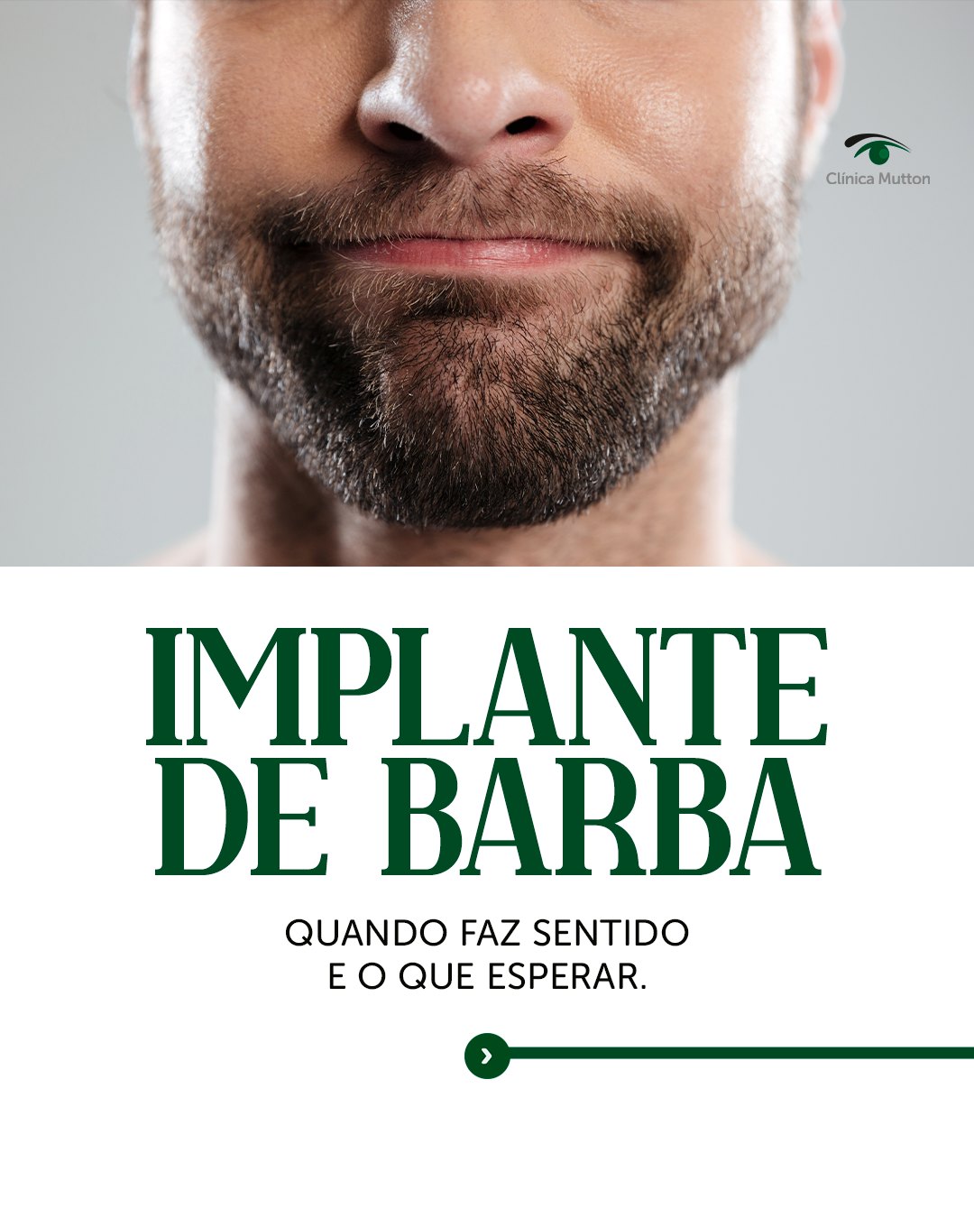 Falhas na barba por genética, cicatriz, queimadura ou acidente têm solução. O implante de barba usa a mesma técnica do transplante capilar, adaptada pro ângulo natural dos pelos faciais.
Nesse post você entende quem procura, como funciona, o que esperar da recuperação e do resultado final.
📅 Agende sua avaliação na Clínica Vanessa Mutton em Sorocaba.