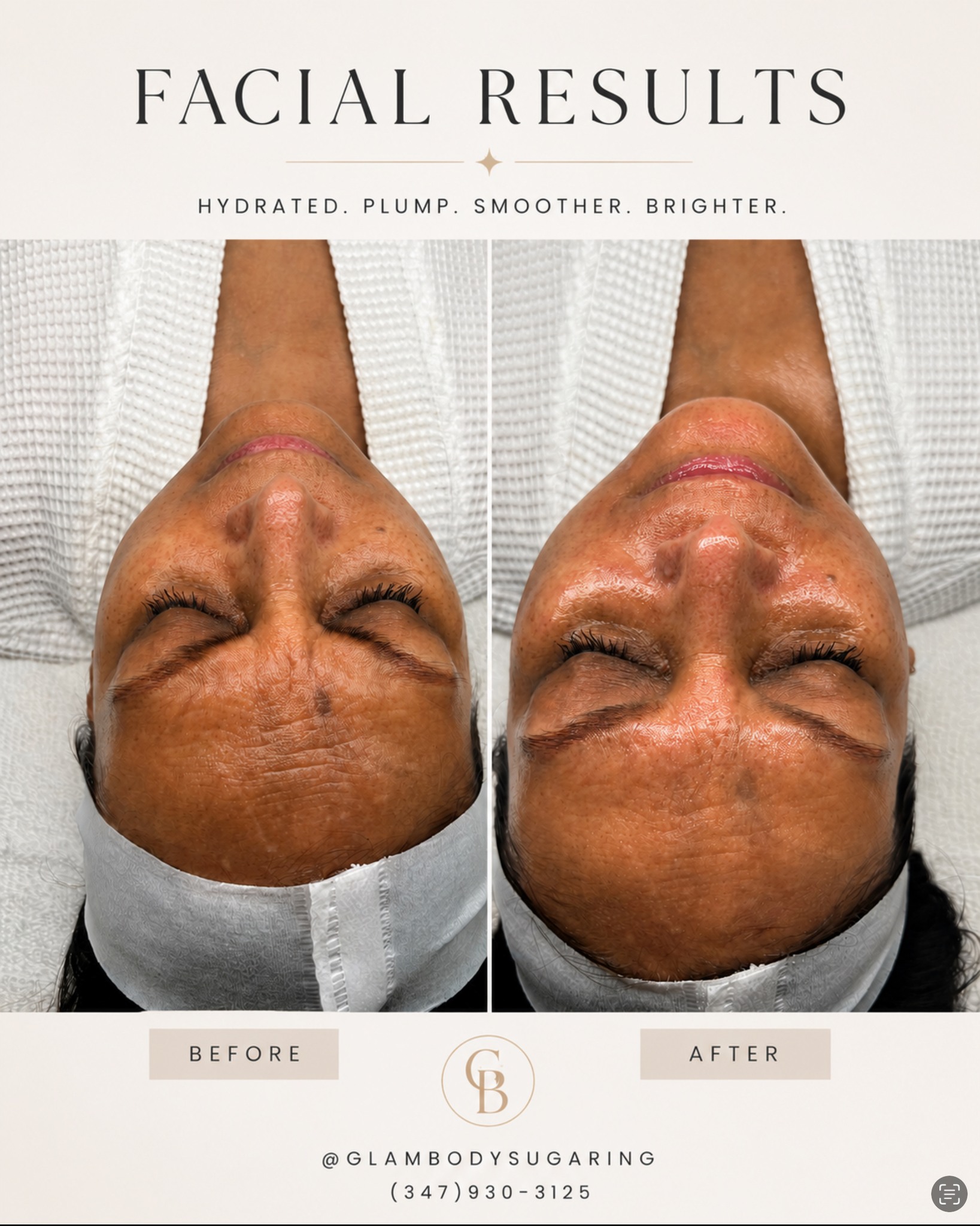 ✨ One facial. Instant glow. ✨
Hydrated skin, improved radiance, smoother texture, and softer-looking fine lines—all after just one treatment. Healthy skin is always in style. 🤍
Ready for your glow-up?
📍DM to book or call (347) 930-3125.
⸻ #nycesthy #esthetician #facialtreatment #glowyskin #queensny #glambodysugaring