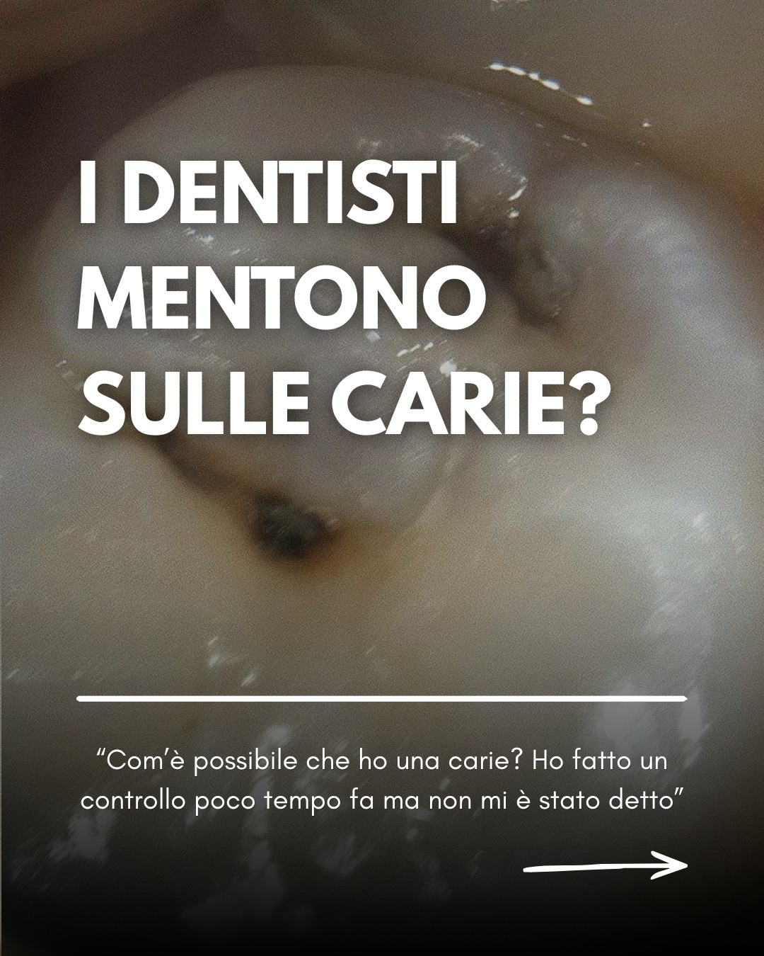 Ti è mai capitato di pensare: "questo dentista mi starà dicendo la verità?"
Un esame diagnostico che include fotografie intra-orali può togliere ogni dubbio, come è successo a quest* nostr* paziente.
Pochi giorni prima aveva effettuato una seduta di igiene presso un altro studio, dove però non avevano evidenziato la presenza di una carie che, invece, era evidente anche a occhio nudo.
Il @doc_claudiomarinelli a corredo della diagnosi, ha mostrato a quest* paziente le fotografie che ha scattato passo, passo durante la terapia di rimozione e restauro di un dente cariato.
Un dente che, a causa di una mancata diagnosi, rischiava di dover essere devitalizzato, con costi biologici ed economici molto maggiori per quest* paziente.
Scegli bene il tuo dentista.
Non ti mentirà.