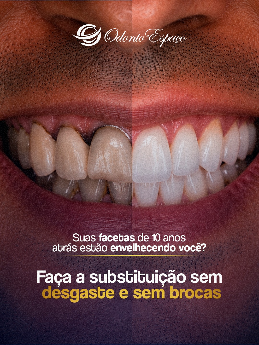 Remoção de facetas antigas com laser e trauma zero. Conheça a tecnologia Erbium:YAG exclusiva da OdontoEspaço. +
⠀
Muitos pacientes adiam a necessária atualização de suas lentes de porcelana antigas por um receio compreensível: o medo do desgaste excessivo nos dentes e do desconforto causado pelas brocas tradicionais. 🏛️✨
Na OdontoEspaço, nós eliminamos essa barreira com a precisão do Laser Erbium:YAG. Esta tecnologia atua por seletividade óptica, removendo as facetas e coroas antigas de forma ultrarrápida. O laser age exclusivamente na camada de cimento, preservando 100% do seu esmalte dentário natural intacto, sem o trauma das vibrações e do desgaste mecânico. 🔬⚡
Logo após essa remoção segura, utilizamos o scanner intraoral 3Shape para a confecção das suas novas lentes ou facetas. O escaneamento digital elimina as moldagens com massa e garante um encaixe milimétrico e muito mais rápido, desenhado sob medida para a anatomia atual do seu rosto.
Eleve a estética do seu sorriso com o rigor científico e a tecnologia que respeitam a sua estrutura viva.
👉 Experimente a evolução da odontologia. Clique no link da nossa bio e agende sua consulta tecnológica. 📩
#LaserErbiumYAG #3Shape #OdontologiaALaser #RemocaoDeLentes #OdontoEspacoPremium #VilaMariana #EsteticaDental #PrecisaoCientifica #TecnologiaALaser #VilaMariana #OrtodontiaEstetica #odontoespaço #dentistavilamariana #vilamarianasp #VilaMariana #ortodontia #ortodentista #dentistasp