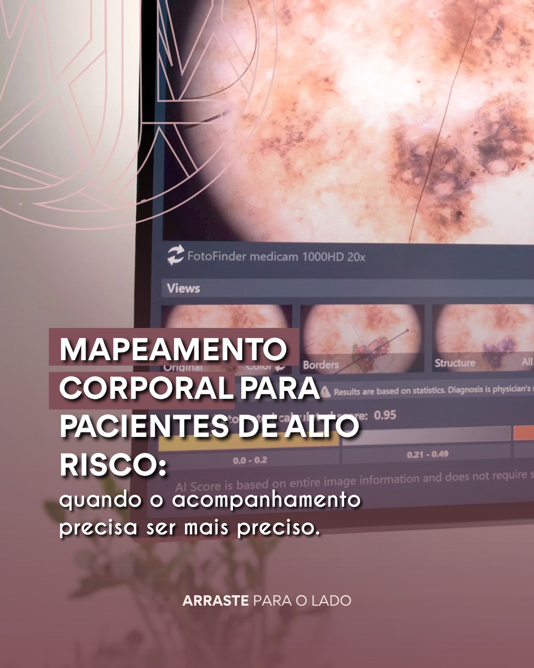 Para pacientes com maior risco de melanoma, acompanhar a pele ao longo do tempo é tão importante quanto realizar uma boa avaliação em cada consulta.
O mapeamento corporal permite o acompanhamento mais preciso e ajuda a evitar procedimentos desnecessários em lesões que permanecem estáveis.
Cada paciente tem um perfil de risco diferente. Por isso, a indicação do mapeamento deve ser feita de forma individualizada pelo dermatologista.
Dra. Júlia Lóss - Médica Dermatologista Oncológica
CRM 5201085638 RQE 34041
#DermatologiaOncologica #DermatologistaNiteroiRJ #DermatologiaNiteroi #MapeamentoCorporalDigital #Melanoma