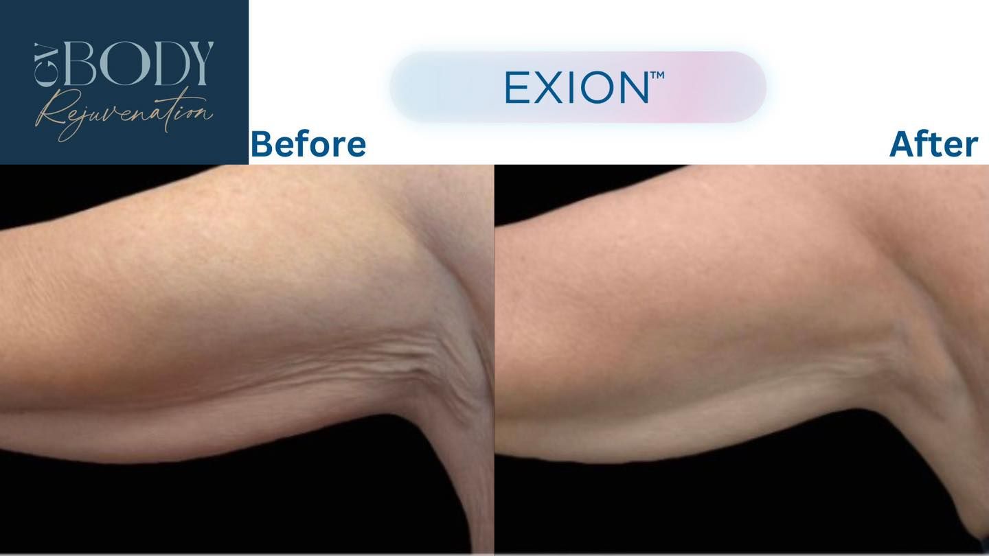 Loose skin and stubborn upper arm fat can be frustrating, especially when diet and exercise aren’t enough.
With Exion Body, we can target the upper arms to help reduce fat while simultaneously supporting skin tightening, creating a smoother, firmer and more toned appearance.
🔹 Most clients have 1 treatment per week for 4 to 6 weeks
🔹 Treatment time is only around 30 minutes
🔹 No downtime: return straight to work, the gym or your normal daily activities
🔹 Non-invasive and comfortable
One of the biggest advantages of Exion Body is its ability to address both fat reduction and skin laxity in the same treatment, making it an excellent option for women noticing changes with ageing, weight loss or perimenopause.
Every treatment plan is personalised because every body is different.
🎯Book your consultation today to see if Exion Body is the right option for your goals.
📍 GV Body Rejuvenation
102 Nixon Street, Shepparton
📞 0407 568 591
#ExionBody #ArmContouring #SkinTightening #BodyContouring #GVBodyRejuvenation