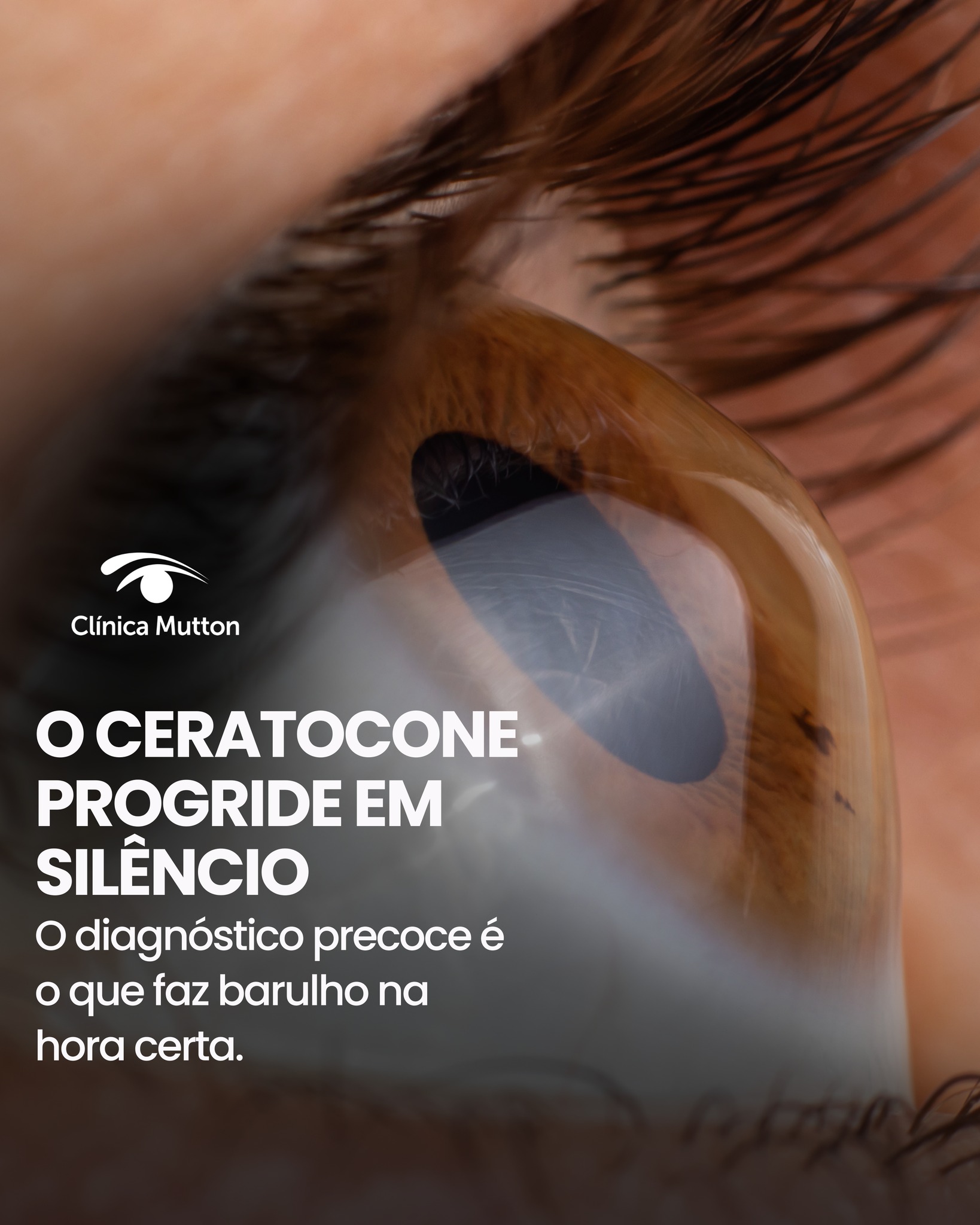 A maioria dos jovens com ceratocone passa anos atribuindo os sintomas ao grau alto ou ao astigmatismo. A visão vai piorando aos poucos e o olho vai se adaptando — até o ponto em que as opções de tratamento ficam mais limitadas. 👁️
Diagnosticar cedo não significa operar na hora. Significa entender o que está acontecendo com a sua córnea antes que a doença decida por você.
Se você tem visão que nunca fica totalmente boa, grau que muda com frequência ou sensibilidade excessiva à luz — não ignore esses sinais. 💙
📍 Agende sua avaliação pelo link na bio.
Dr. Fernando Mutton
CRM SP 803999
RQE 20279
Dr. Gabriel Mutton
CRM 264060
#ceratocone #saúdeocular #oftalmologista #córnea #oftalmologiamutton