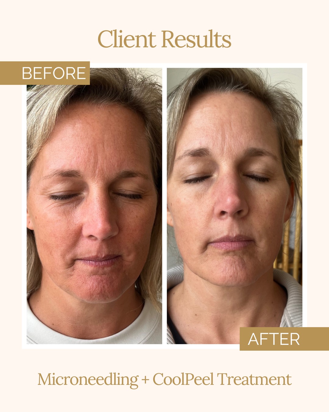 Microneedling + CoolPeel results that speak for themselves 🤍❄️🤩 A little consistency and the right treatments can make all the difference!
For August only, purchase a package of PRX, Microneedling, Non-Surgical Bleph, or Neck Rejuvenation and receive a FREE CoolPeel treatment ($750 value)!
Give us a call or click the link in our bio to book your treatment today ✨