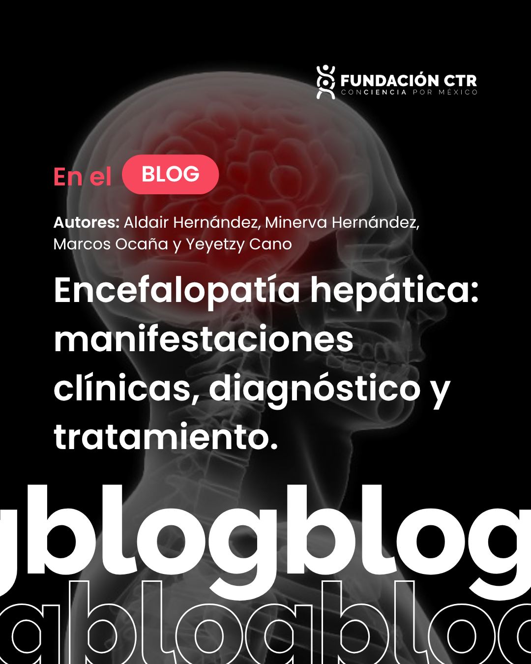 ¿Sabías que cuando el hígado falla, el cerebro también sufre? 🧠⚠️
Si el hígado no logra limpiar las toxinas del cuerpo, estas viajan por la sangre hasta el cerebro, causando confusión, fallas de memoria o cambios de conducta. A esto se le llama encefalopatía hepática.
Descubre cuáles son las señales de alerta y cómo se trata en nuestro nuevo artículo por Aldair, Minerva, Marcos y Yeyetzy.
🔗 Lee la nota completa en el enlace de nuestro perfil.
#FundaciónCTR #SaludHepática #SaludParaTodos #BlogCTR #Prevención
