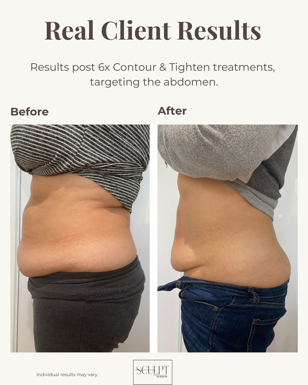 Those amazing results hit differently.... especially when the client is sceptical!
This gorgeous client trusted us with 6x Contour & Tighten treatments specifically targeting the abdomen. These results speak for themselves 👏
🌟Real client. Real treatments. Real results. 🌟
Ready to work towards your body goals?
📲 DM us or book your complimentary consultation via the link in our bio
📍Joondalup
💰$89 per treatment
🌟6 treatment package: $469- save $65
.
Individual results may vary.
.
#BodySculptingPerth #FatCavitationPerth #RFSkinTighteningPerth #ContourAndTighten #PerthBodyContouring #PerthBeauty #RealResultsRealClient #SculptAndGlowLAB