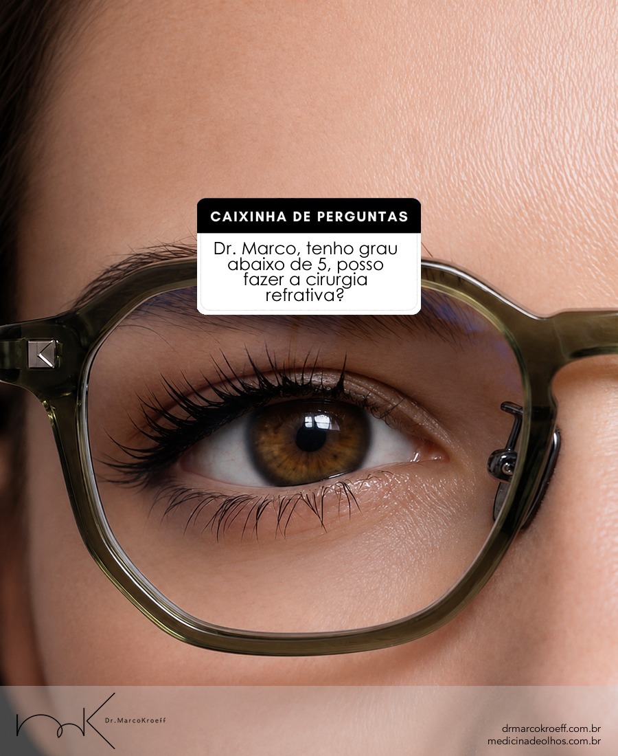 Sim, é possível! Essa é uma dúvida bastante comum: mesmo quem tem poucos graus pode ser candidato à cirurgia refrativa.
Em alguns casos, o procedimento pode ser considerado a partir de aproximadamente 0,5 grau. Portanto, pessoas com miopia, hipermetropia ou astigmatismo de 1, 2 ou 3 graus também podem ter indicação para a cirurgia.
Mas o número do grau, sozinho, não determina se o procedimento pode ser realizado. Alguns critérios são especialmente importantes:
Estabilidade do grau: é fundamental que a refração esteja estável, geralmente por pelo menos um ano. Isso ajuda a proporcionar maior previsibilidade e durabilidade ao resultado.
Idade e maturidade visual: em geral, a cirurgia é considerada após a estabilização do desenvolvimento ocular. A idade recomendada pode variar conforme o caso e a avaliação médica.
Além disso, antes de qualquer indicação, é necessária uma avaliação oftalmológica completa. Exames específicos permitem analisar fatores como espessura e formato da córnea, saúde da superfície ocular, características do grau e condições gerais dos olhos.
Por isso, mais importante do que perguntar “quantos graus são necessários para operar?” é descobrir se os seus olhos apresentam as condições adequadas para uma cirurgia refrativa segura e bem indicada.
A decisão é sempre individual e deve ser tomada em conjunto com o oftalmologista após uma avaliação detalhada.
#DrMarcoKroeff #CirurgiaRefrativa #LiberdadeVisual #Felicidade #SaudeOcular"
Agende sua consulta, terei o maior prazer em dar a melhor orientação.
Dr. Marco Antônio Kroeff
Primar Oftalmologia POA ✆ 3222.7974
Clínica Otovisão Gravataí ✆ 3497.6000
www.drmarcokroeff.com.br