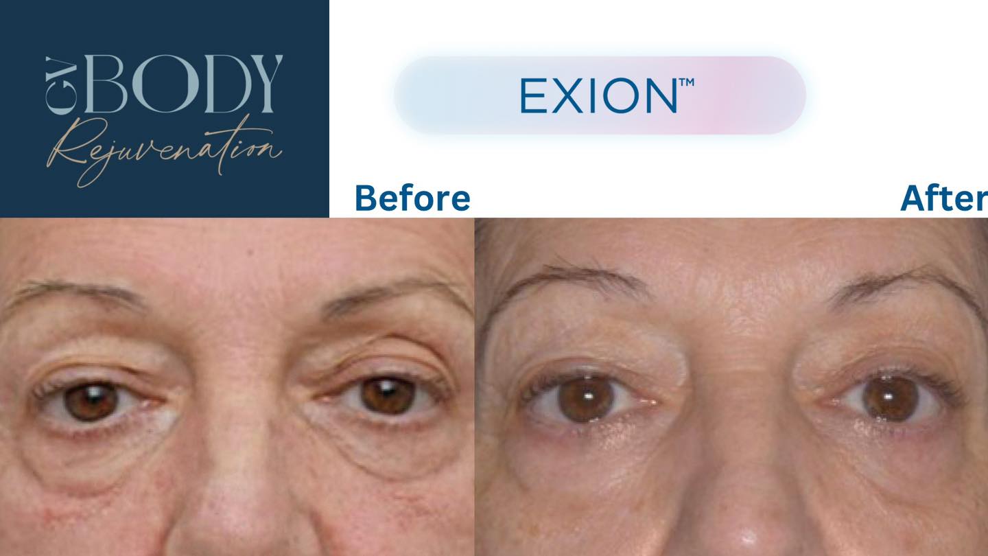 The under-eye area needs a different approach.
The skin around our eyes is some of the thinnest and most delicate skin on the face, which is why changes in collagen, elasticity and hydration can become noticeable here early.
Fine lines, crepey texture and skin laxity around the eyes can all contribute to that tired appearance, even when you’re anything but.
This is an area where EXION Face can be directly and precisely targeted.
EXION combines monopolar radiofrequency with targeted ultrasound, delivering controlled energy to support natural skin regeneration without needles or invasive procedures.
Around the delicate eye area, our goals are to:
🔹 Stimulate collagen and elastin production
🔹 Improve firmness and elasticity
🔹 Support natural hyaluronic acid production and hydration
🔹 Improve crepey skin texture
🔹 Soften the appearance of fine lines
🔹 Support stronger, healthier-looking skin
The treatment is comfortable, non-invasive and requires no downtime. You can literally have your treatment and get straight back to your day.
And because EXION can be targeted to specific areas, we can focus treatment where your skin actually needs it rather than taking a one-size-fits-all approach.
Concerned about under-eye laxity or crepey skin? Book a free consultation and we can discuss whether EXION is appropriate for you.
GV Body Rejuvenation
102 Nixon St, Shepparton
0407 568 591
#EXION #EXIONFace #UnderEyeTreatment #SkinTightening #CollagenStimulation #SkinRejuvenation #Shepparton #GVBodyRejuvenation