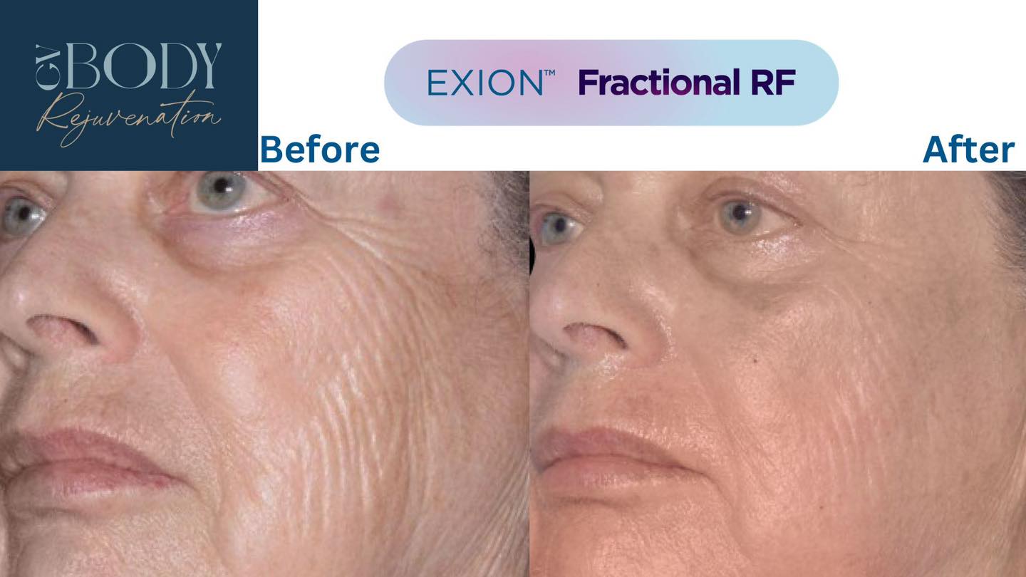 Two technologies. One treatment. One goal: healthier, firmer, smoother skin.
EXION Fractional RF is often referred to as RF microneedling, because it combines two skin rejuvenation technologies in the one treatment.
🔹 Microneedling creates controlled micro-injuries within the skin, triggering the body’s natural repair response and stimulating new collagen and elastin.
🔹 Fractional radiofrequency (RF) delivers targeted thermal energy into the deeper layers of the skin, further stimulating collagen remodelling and supporting firmer, tighter skin.
By combining the mechanical stimulation of microneedling with controlled RF energy, we’re essentially delivering two complementary treatments at the same time.
The aim? To progressively improve concerns such as:
• Fine lines and wrinkles
• Skin laxity and loss of firmness
• Crepey skin
• Uneven skin texture
• Enlarged pores
• Acne scarring
• Overall skin quality
A series of treatments is generally recommended for optimal results, as collagen and elastin remodelling occurs progressively over time. Your treatment plan is tailored to your skin, concerns and goals.
And because great results aren’t just about what happens during your appointment, our EXION Fractional RF packages include your in-clinic after-care PLUS a take-home after-care pack at no additional cost.
Your skin is supported through the treatment and recovery process, with a focus on skin health as well as results.
EXION Fractional RF isn’t suitable for everyone. A FREE consultation is required before booking so we can assess your skin, discuss your concerns, review suitability and determine whether Fractional RF is the right treatment option for you.
📍 GV Body Rejuvenation
102 Nixon Street, Shepparton
Women’s Health Nurse owned & operated
📞 0407 568 591
Book your FREE consultation online to get started.
#EXIONFractionalRF #RFMicroneedling #MicroneedlingShepparton #SkinTighteningShepparton #SkinRejuvenation #CollagenRemodelling #SheppartonSkinClinic #GVBodyRejuvenation