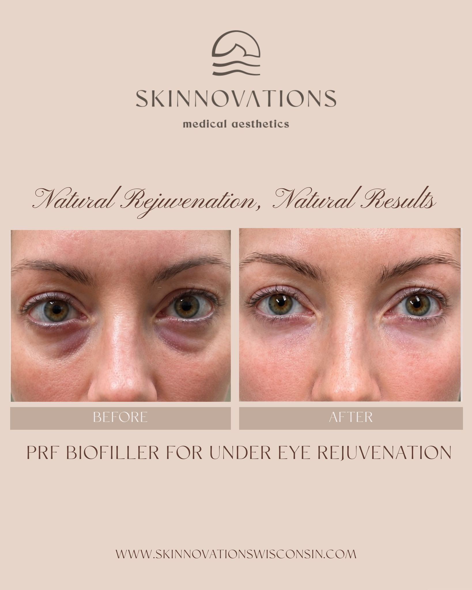 A brighter, more refreshed under-eye area using your body’s own regenerative potential.✨
PRF Biofiller is created from your own blood and used to support natural rejuvenation, improve the appearance of skin quality, and soften the look of dark circles and hollowing beneath the eyes.
Ready to learn if PRF Biofiller is right for you? Schedule a consultation with Skinnovations.
📱715.506.2222
#biofiller #prf #skinnovations #wausau #medicalaesthetics #nursepractitioner