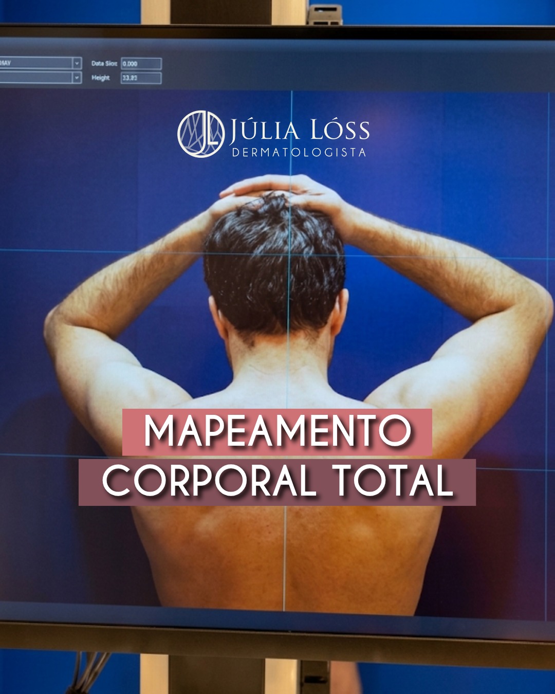 O mapeamento corporal total é uma importante ferramenta para o acompanhamento de pacientes com maior risco para melanoma.
É especialmente indicado para quem apresenta múltiplos nevos, nevos atípicos, histórico pessoal ou familiar de melanoma e outros fatores de risco para a doença.
Dra. Júlia Lóss - Médica Dermatologista Oncológica
CRM 5201085638 RQE 34041
#fotofinder #dermatoscopia #cancerdepele #MapeamentoCorporaltotal #Melanoma