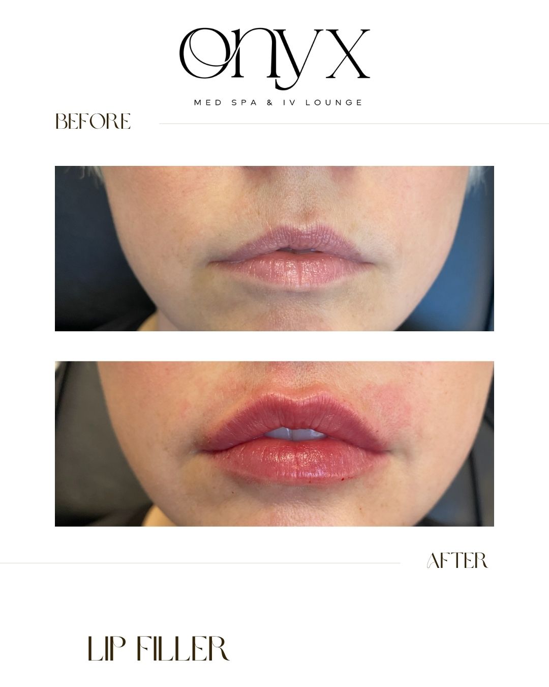 Achieving the perfect pout is all about precision! We enhanced her cupid’s bow and added volume for a beautifully defined and hydrated look!
Book your session online today! 📲
#filler #lipinjections #RestylaneKysse #lipfiller #cosmetics #fillers #lips #cosmeticinjectables #injectables #medicalspa #medspa #lipfillers #skin #antiaging #antiwrinkleinjections #medicalaesthetics #medispa #loveyourlips #aesthetics #dermalfiller #injections #wrinkles #onyxmedspa #arinjections #arkansasmedspa