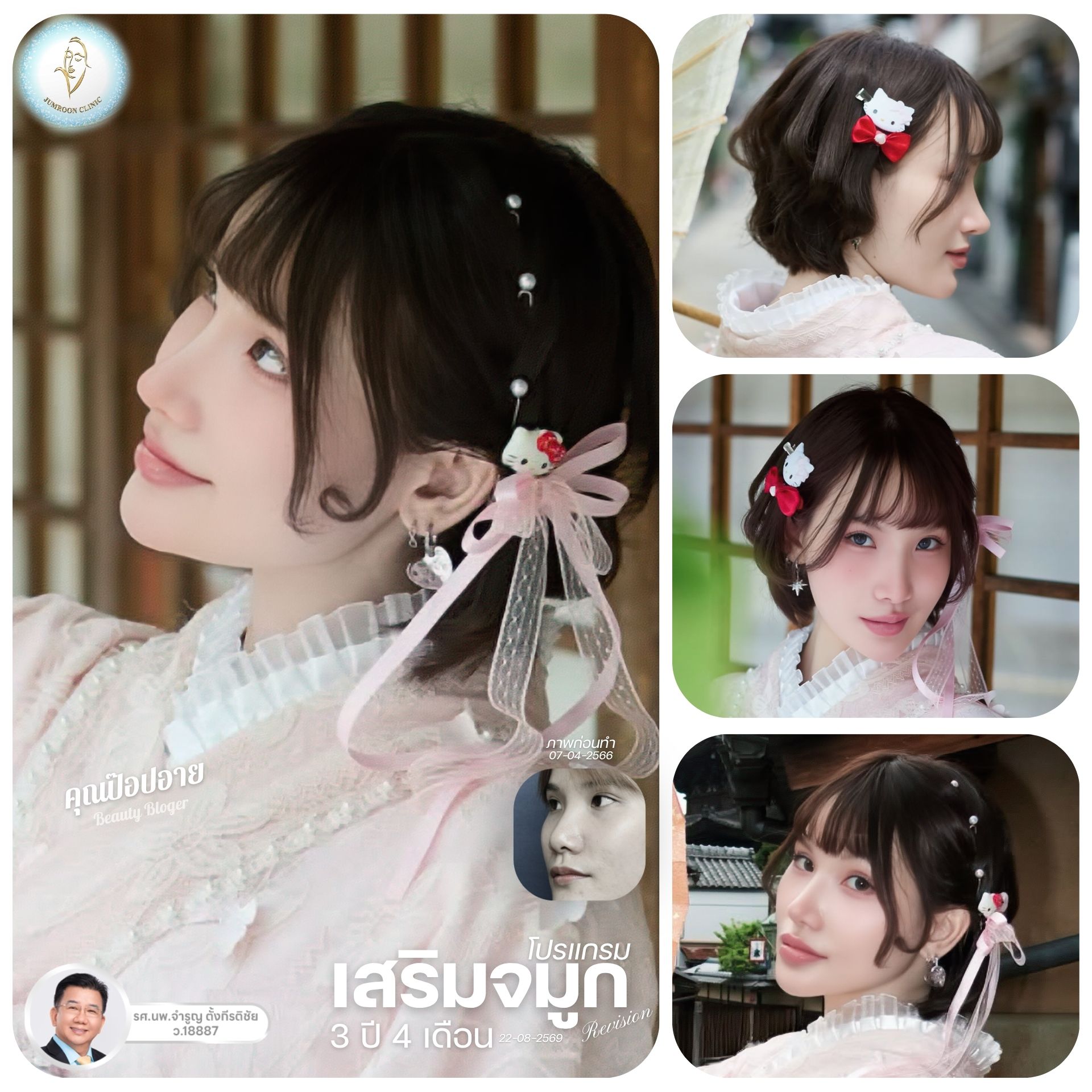 🌸 กาลเวลาพิสูจน์ความสวยลงตัว... เมื่อจมูกคือศูนย์กลางแห่งความงามของใบหน้า ✨
อัปเดตผลงานเสริมจมูกงานใหม่ยาวนานถึง 3 ปี 4 เดือน ของ "คุณป๊อปอาย" Beauty Blogger คนสวย ในชุดกิโมโนลุคญี่ปุ่นสุดน่ารัก! 👘💖
ผลงานการรังสรรค์โดย อาจารย์จำรูญ ด้วยเทคนิค Close ร่วมกับการคล้องปีกจมูก ที่ออกแบบให้ทรงจมูกเป็น "จุดศูนย์กลาง" ในการเชื่อมโยงมิติของใบหน้าเข้าด้วยกัน ทั้งสันจมูกสโลปหวาน ปลายพุ่งกำลังดี และปีกจมูกที่เรียวเข้าทรงอย่างเป็นธรรมชาติ ช่วยขับเน้นให้ดวงตา รอยยิ้ม และโครงหน้าโดยรวมดูละมุน สดใส และสวยหวานสไตล์ญี่ปุ่น 📸🇯🇵
ผ่านไปกว่า 3 ปี ทรงจมูกยิ่งรัดแกนสวยเป๊ะ ทนทาน และลงตัวในทุกมุมมอง 💎
#อัพเดททรงจมูก
สนใจปรึกษา | นัดคิวล่วงหน้า
✅ ให้คำปรึกษาโดยหมอจำรูญ @จำรูญคลินิก
✅ ทานยาเคลิ้มหลับ
✅ บริการล้างแผล,ตัดไหม,ติดตามอาการ (After care)
✅ คุณหมอออกแบบ วิเคราะห์ใบหน้าเคสbyเคส ด้วยศาสตร์ Facial Plastic
__________________________________
ข้อมูลการติดต่อ
(联系方式)
☎️โทร : 088 663 6554
☎️โทร : 082 545 5997
💚ID Line : @jumroonclinic
#เสริมจมูกโอเพ่น #เสริมจมูกOpen
#จมูกโอเพ่น #จำรูญคลินิก #นางฟ้าอ่าวไทย
#จำรูญคลินิก #ศัลยกรรม #ศัลยกรรมตกแต่งใบหน้า #จมูก #โปรแกรมศัลยกรรมจมูก #จมูกเนื้อเยื่อเทียม #ซิลิโคนหลังหู #จมูกเอียง #ปรับจมูกเอียง #ตัดเหนียง #โปรแกรมศัลยกรรมคาง #โปรแกรมยกหน้า #โปรแกรมดึงหน้า #ศัลยกรรมยกหน้า #ศัลยกรรมใบหน้า #จมูกผู้ชาย #rhinoplasty #นายแพทย์จำรูญแพทย์facialplastic #จำรูญคลินิกสามเสน #ดึงหน้า #ดึงหน้าผาก #ดึงขมับ #ดึงแก้ม #โปรโมชั่น