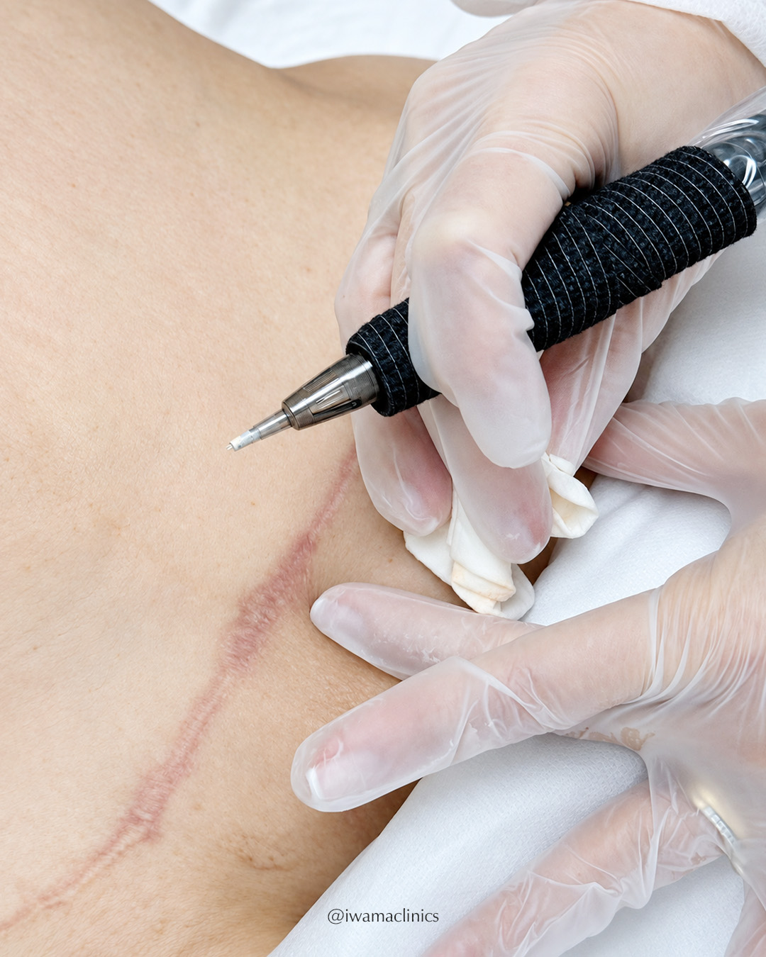 This procedure is called Scar Color Equalization.
It softens the visible contrast between the scar and the surrounding skin, creating a more natural transition and helping the area feel more integrated.
Sometimes, restoration means finally wearing the swimsuit that inspired the surgery in the first place.
Other times, it’s looking in the mirror without your eyes going straight to the scar.
Or realizing you chose what to wear without thinking about whether it would show.
Those are the quiet changes our clients often value most.
If you would like to understand what may be possible for your scar, send us a message.
Our team will take a closer look at your case and guide you with clarity and care.
With care,
Iwama Clinics 🤍
📞 (754) 232-7960
🌐 priscilaiwama.com
#scarcolorequalization #scarequalization #tummytuckscar #scarrestoration #medicaldermopigmentation #skinrestoration #iwamaclinics #bocaraton