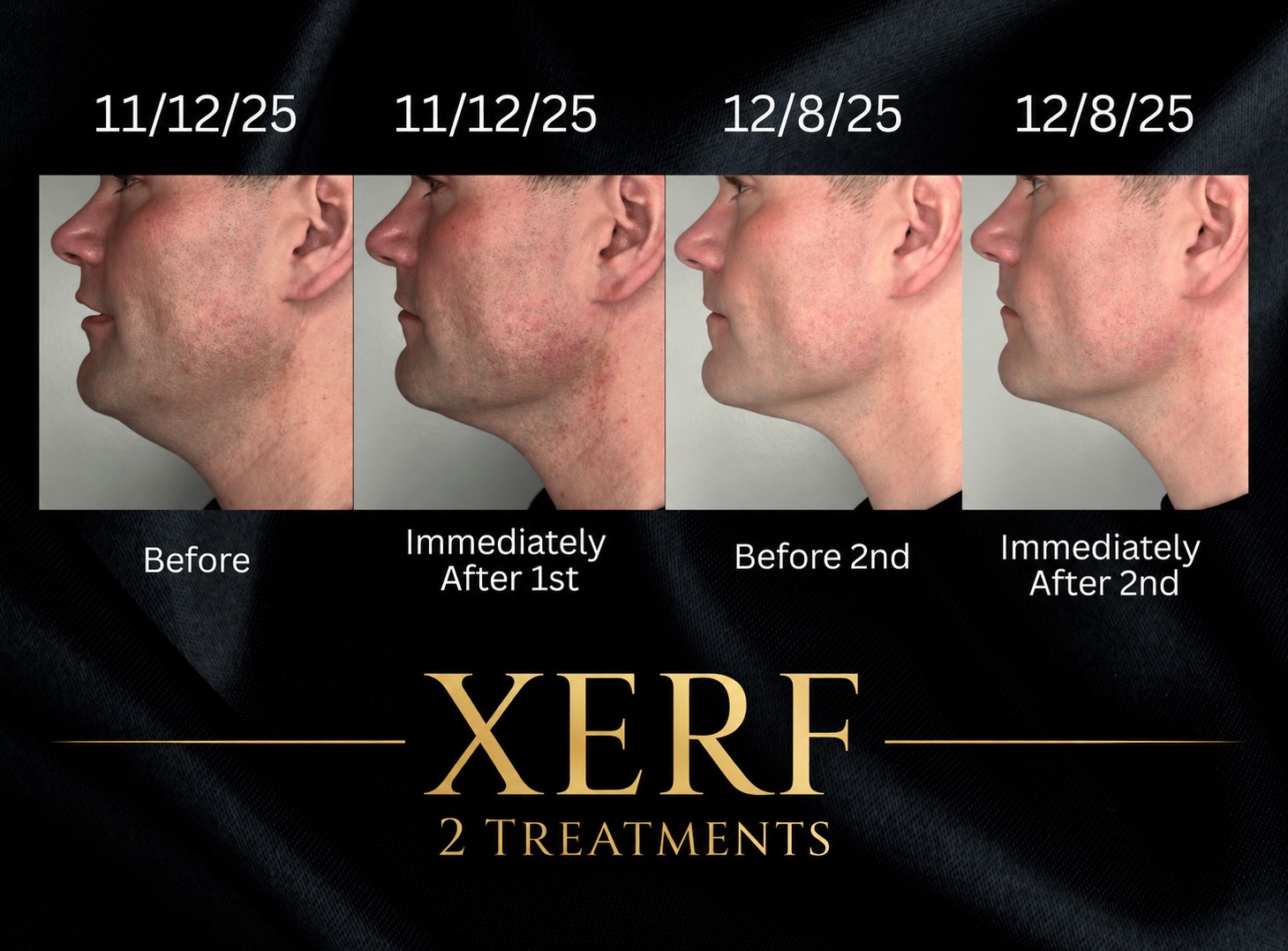 Men can benefit from XERF, too.
These results are a great example of how aesthetic treatments don’t have to mean looking “done”—sometimes the goal is simply to look more defined, refreshed, and confident.
After just 2 XERF treatments, notice the improvement in the appearance of the jawline, lower face, and under-chin area. XERF uses advanced radiofrequency energy to heat deeper layers of tissue, supporting collagen remodeling and gradual skin tightening—with no needles, no surgery, and minimal downtime.
For men, XERF can be a great option for addressing:
👉 Loss of jawline definition
👉 Skin laxity under the chin and along the neck
👉 Early signs of aging
👉 Overall skin firmness and texture
And because collagen remodeling continues after treatment, results can continue to develop over time.
📸 Results courtesy of Bella Vida Medspa
Individual results vary.
Call or Text 218-454-5248 to schedule your XERF today.
#XERF #XERFForMen #MensAesthetics #MensSkincare #JawlineDefinition #Brainerdlakesarea #SkinTightening #NonSurgicalSkinTightening #CollagenRemodeling #BrainerdMN #MinnesotaAesthetics #LakesAreaIVWellnessAndAesthetics