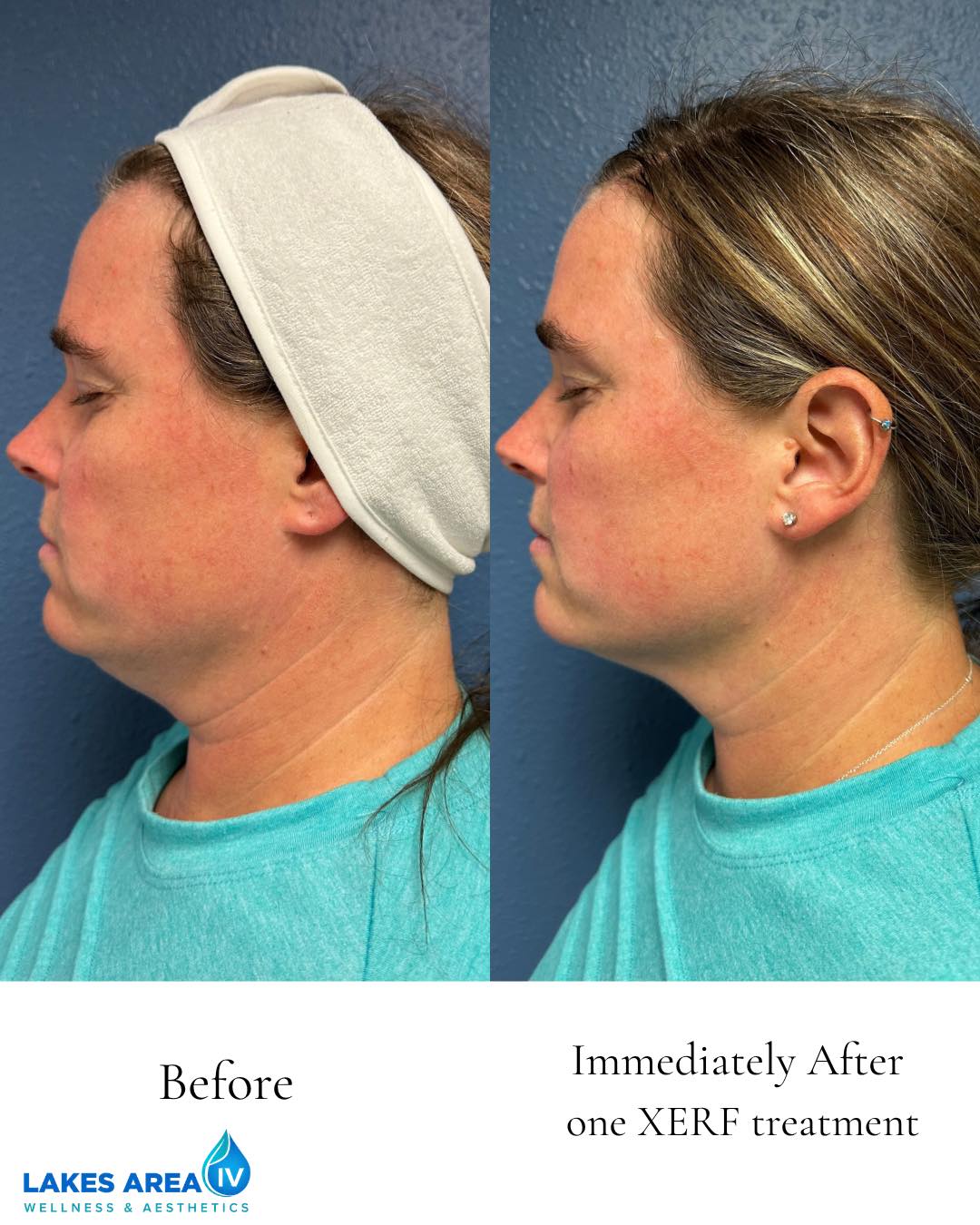 One XERF treatment. And this is IMMEDIATELY after. 👀
Our own Jenna tried XERF, and we are loving what we’re seeing already. Look at the definition through her jawline, the tighter appearance of her neck and lower face, and the softening around her nasolabial folds.
But here’s what makes XERF so exciting: this is only the beginning.
XERF delivers controlled radiofrequency energy into the deeper layers of the skin, creating an immediate tightening response while stimulating collagen and elastin remodeling. Over the weeks and months that follow, that remodeling process continues—meaning the results you see right after treatment can continue to develop.
Think firmer. Tighter. More defined. Without looking like you had something “done.”
And XERF isn’t just for the face and neck. We can customize treatment for multiple areas of the body where skin laxity is a concern.
Curious what XERF could do for your skin?
Come see us for an XERF consultation. We’ll assess your skin, talk about the areas that bother you, and create a treatment plan specifically for you.
📲 XERF consultations are now booking at Lakes Area IV Wellness & Aesthetics.
Call or Text 218-454-5248
#XERFSkinTightening #BrainerdLakesArea #SkinTightening #CollagenRemodeling #lakesareaivwellness