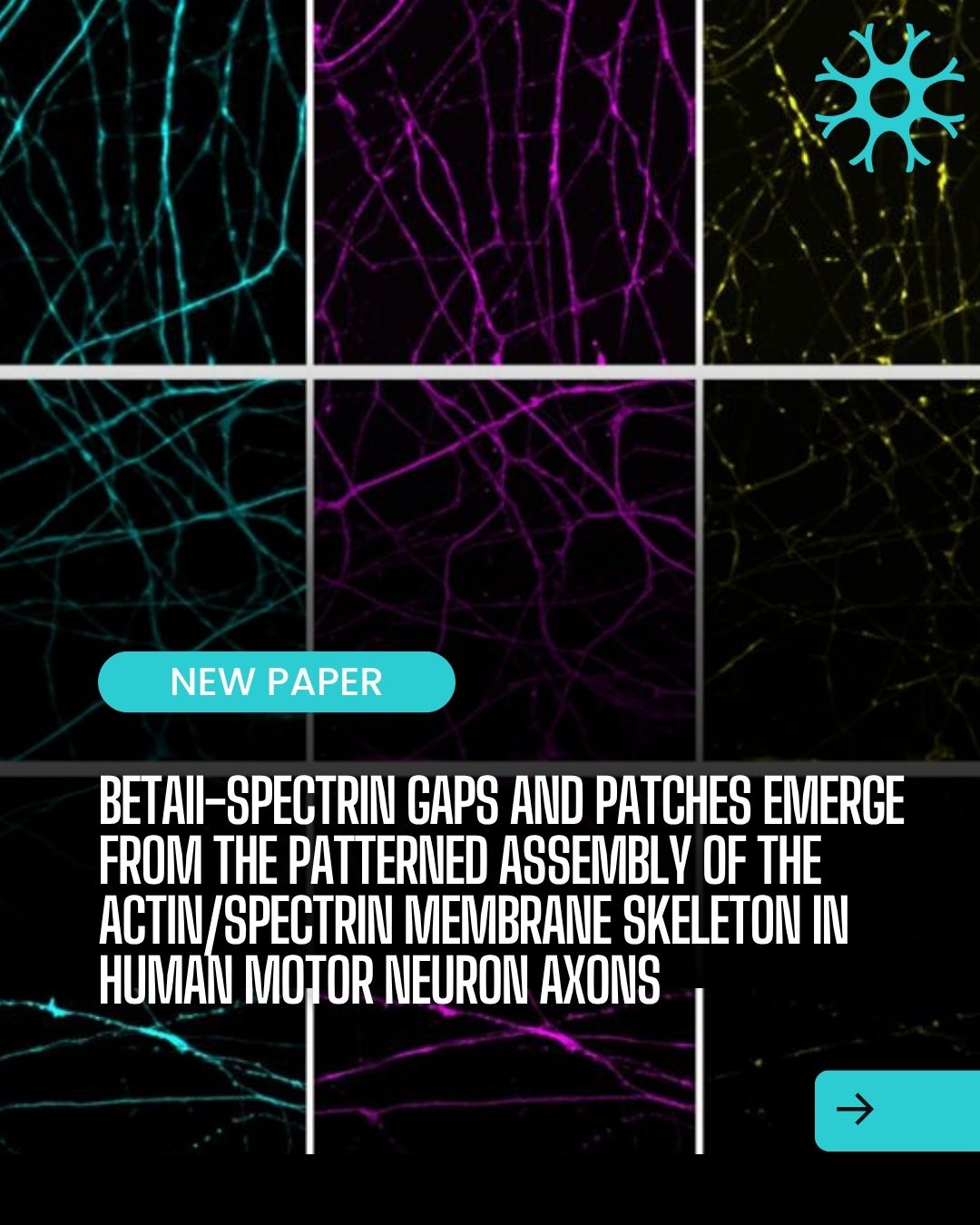 🧠 New paper alert! Excited to share our latest collaborative work on the cytoskeleton that keeps our neurons wired for the long haul. This study, using human iPSC-derived motor neurons, gives us a new lens on how the axonal nanoscale cytoskeleton self-organizes — and a foundation for understanding how this organization might be altered in disease conditions.
Big congratulations to Dr. Nicolas Unsain, Dr. Nahir Guadalupe Gazal, Ph.D. Gazal, Dr. Maria Jose Castellanos-Montiel, and everyone involved!
📄 Read the full paper: https://lnkd.in/gC9Xi43g
#Neuroscience #StemCellBiology #ALS #Cytoskeleton #MotorNeurons #iPSC