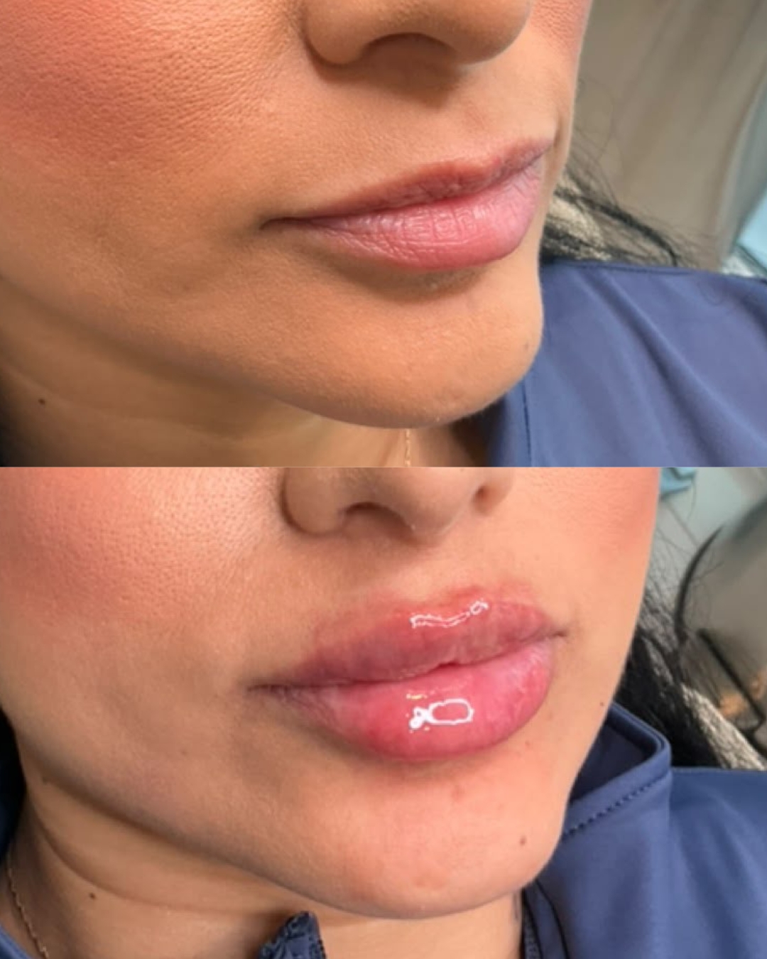 The perfect pout is all about balance. 💋✨
Add a touch of volume, enhance your natural shape, and enjoy beautifully soft, fuller-looking lips that still feel like YOU. 💕
Ready to give your lips a little love? Book your appointment today! 💌
#LipFiller #NaturalLipEnhancement #AestheticTreatments #LipEnhancement #SoftLips #BeautyBoost #beautifulcosmeticsmd #Chino #California
📍 Beautiful Cosmetics MD
3857 Schaefer Ave, Chino, CA 91710, United States