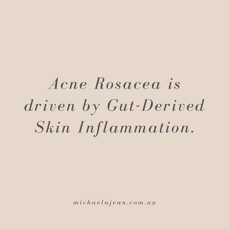EYYYYYYEEEE-YEYYYYYY YEYYYYY!!!! How down in the dumps do you feel when your skin flares up?!?!
Its just bottoms-up I want to cry a river because my face is hot and I can feel those little weird pimples bubbling away and I just feel like NOTHING I DO WORKS?!?!!
I get you. I’ve been there. And I have supported a myriad of young women and men with this complex little cookie of a life-downer. My people —> it’s time we look to your gut🧞♀️.
One of the greatest common denominators for Rosacea / Acne Rosacea is dysbiosis AKA gut-derived skin inflammation, usually involving a microbial overgrowth and intestinal-wall hyper-permeability. THIS my people generally requires herbal intervention, and an individualised approach is a must. Sometimes you may not even have any gut symptoms at all (or perhaps you’re just so used to them you think they are normal???? This is SUPER common).
Some of the symptoms to watch out for:
⬇️ Burping / hiccuping during or between meals (this indicates your stomach acid is weak which is a HUGE player in rosacea and other inflammatory skin conditions)
⬇️ Diarrhoea / loose bowel movements
⬇️ Constipation / partial evacuation
⬇️ Stomach pain
⬇️ Gas
⬇️ Feeling “easily full” or experiencing indigestion
⬇️ Nausea
⬇️ Reflux or heartburn
⬇️ And of course our long lost nemesis - the abdominal bloat
If you experience any of these symptoms, and even if you don’t - chronic inflammatory / papule + pustule rosacea will invariably need some gut love to resolve. And in the meantime until you get a chance to consult a Naturopath swipe left for a few dietary/lifestyle tips on how to calm that beautiful face of yours down ❤️❤️❤️