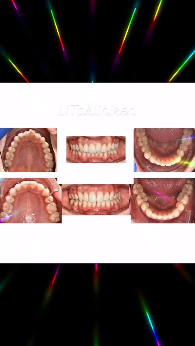 Före & Efter (vuxen)
Korrigering av postnormalt bett med stor horisontell överbitning (9 mm), djupt bett, unilateral saxbitning, anterior trångställning och proklinerade incisiver samt läppdysfunktion 😬
Behandling bestående av extraktion av 4 premolarer och fastsittande tandställning (”räls”) i 2 år 😀
Vi tackar vår fina patient för ett gott samarbete! 🙏
Vi vill passa på att önska alla en trevlig helg! ☀️