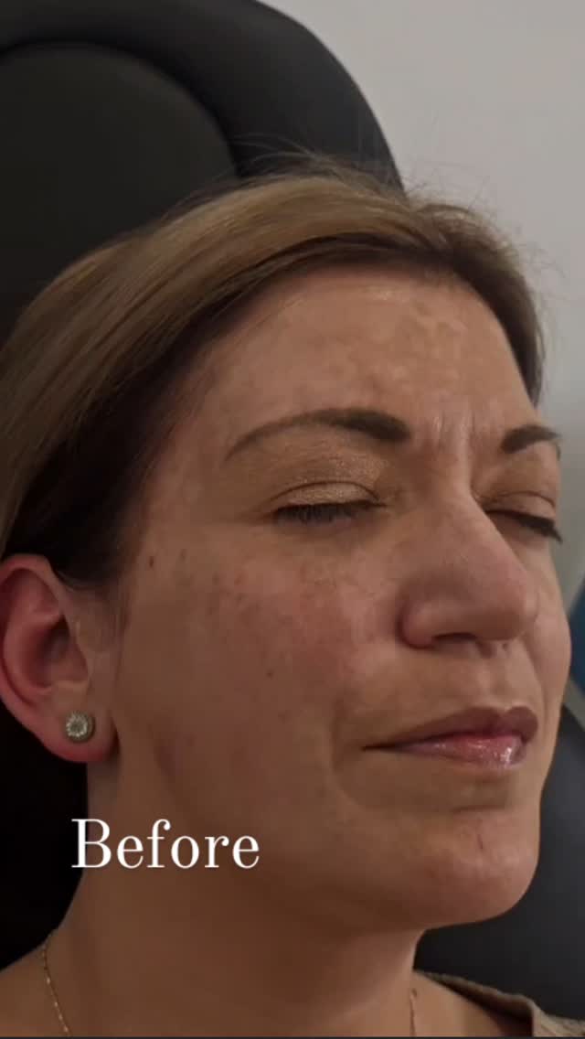 PicoSure is your solution for melasma and pigmentation—restoring a flawless, radiant complexion.
#TattooRemoval
#PermanentMakeupRemoval
#PMURemoval
#PicoSureTattooRemoval
#LaserTattooRemoval
#WindsorTattooRemoval
#DetroitTattooRemoval
#TattooRemovalWindsor
#TattooRemovalDetroit
#RemoveTattoo
#TattooRemovalSpecialist
#ClearSkinJourney
#EraseTheInk
#TattooRemovalExperts
#PMUTattooRemoval
#GoodbyeInk
#LaserAway
#PicoLaserRemoval
#CosmeticTattooRemoval
#WindsorLaserClinic
#DetroitBeauty
#LaserAesthetics
#TattooFading
#TattooFree
#Detriot
#Windsor
#Montellbeauty