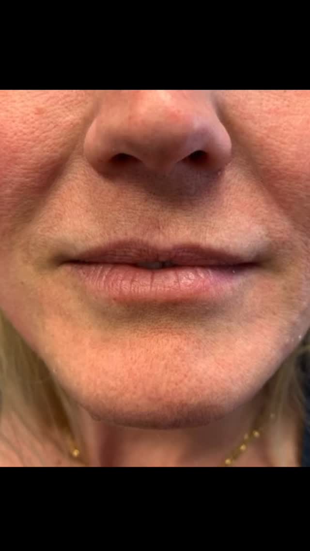 Roses are red, violets are blue, your lips are perfect, but a little filler wonโt hurt too! ๐๐
.
Subtle, plump, and kissable just in time for Valentineโs Day. โค๏ธ๐
.
Love is in the air, but so is hyaluronic acid and FreshRx is here for it!!
.
#happyvalentinesday #fortheloveoflipfiller #freshrx #facebyfreshrx #fallstonbotox #fallstonfiller