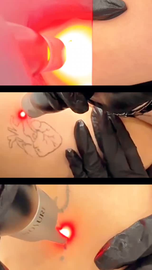 Regret your ink? We’ve got the solution—safe, precise picosure laser tattoo removal.
#TattooRemoval
#PermanentMakeupRemoval
#PMURemoval
#PicoSureTattooRemoval
#LaserTattooRemoval
#WindsorTattooRemoval
#DetroitTattooRemoval
#TattooRemovalWindsor
#TattooRemovalDetroit
#RemoveTattoo
#TattooRemovalSpecialist
#ClearSkinJourney
#EraseTheInk
#TattooRemovalExperts
#PMUTattooRemoval
#GoodbyeInk
#LaserAway
#PicoLaserRemoval
#CosmeticTattooRemoval
#WindsorLaserClinic
#DetroitBeauty
#LaserAesthetics
#TattooFading
#TattooFree
#Detriot
#Windsor
#Montellbeauty