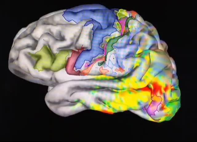 Combining quantitative structural brain measures from MRI with millisecond-wise brain activity measures from MEG in one patient. Building on methods developed more than 10 years ago. Download one of the pubs here:
Atypical right hemisphere specialization for object representations in an adolescent with specific language impairment. Frontiers in Human Neuroscience, Brown et al., 2014.
https://www.frontiersin.org/journals/human-neuroscience/articles/10.3389/fnhum.2014.00082/full
Cheers. 🧠☀️
#MEG #MRI #aMEG