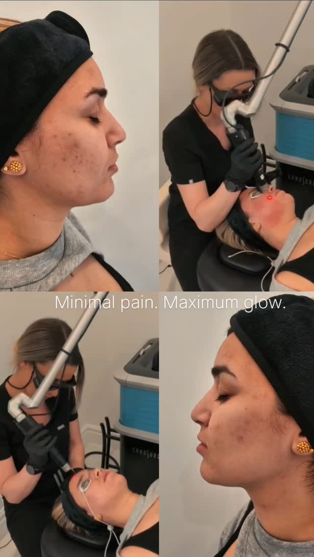 Glow up with every pulse.
Fading acne scars with PicoSure—gentle, powerful, and glow-enhancing ✨️