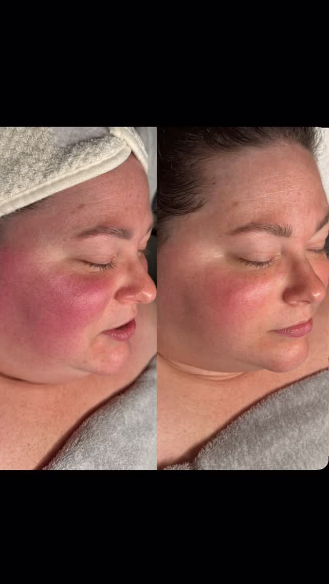 Circadia’s Oxygen Rx 🫧 + LED + Gua Sha/Lymphatic Drainage + Nourishing Scalp Treatment 😌💆🏻♀️
Blown away by these results and excited that this is only the first of a series of facials to target dehydration, puffiness & redness.
#CapCut #fyp #viral #smallbusiness #massagetherapy #circadia #circadianrhythm #facials