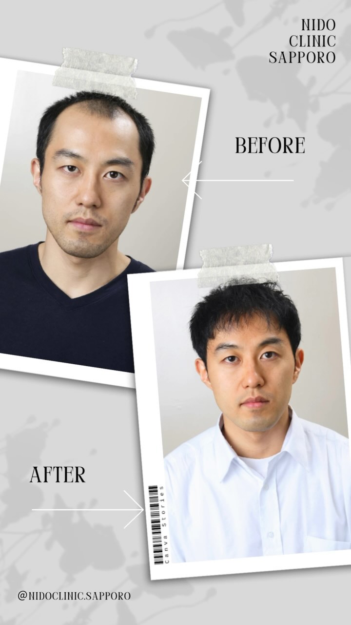 ■施術紹介
💁♂️尾崎様
施術名:自毛植毛
施術の説明:薄毛になりにくい後頭部・側頭部の毛根をに採取し、前頭部や頭頂部の薄くなった部分に移植する手術です。移植した毛髪は薄毛になりにくい性質を保ったまま定着し、一生涯、生え変わりけます。
施術の副作用(リスク):施術に伴い、痛み、赤み・熱感、初期脱毛、切れ毛・抜け毛、つっぱり感、感覚の鈍さ、施
術範囲のの悪化、コメド、毛嚢炎、膨隆、色素沈着、点状出血、内出血、腫脹、灼熱感、瘢痕が生じることがあります。
施術の価格:360,000円~
•*¨*•.¸¸☆*・゚•*¨*•.¸¸☆*・゚•*¨*•.¸¸☆*・゚•*¨*•.¸¸☆*・゚
他の投稿が見たい方は▼
@nidoclinic.sapporo
ご予約・詳しい詳細はプロフィール欄よりお進みください☺️
•*¨*•.¸¸☆*・゚•*¨*•.¸¸☆*・゚•*¨*•.¸¸☆*・゚•*¨*•.¸¸☆*・゚
AGAは正しい知識をもって治療を行う事が大切です。
まずはお気軽に無料カウンセリングにお越し下さい☺️
良ければ【いいね&(フォロー】をお願いします✨
いつでも見返せるように【保存】もよろしくお願いします🙇♂️
•*¨*•.¸¸☆*・゚•*¨*•.¸¸☆*・゚•*¨*•.¸¸☆*・゚•*¨*•.¸¸☆*・゚
ニドークリニック札幌
◼️所在地
📍北海道札幌市中央区南1条西6丁目11番 札幌北辰ビル7階
◼️営業時間
⏰9:30~18:00(受付17:00まで)
🗓️定休日:木曜、第1・3日曜、他隔週月曜
◼️お電話でお問い合わせの際は「Instagramを見た」と仰っていただけるとスムーズです。
📞011-281-0210
•*¨*•.¸¸☆*・゚•*¨*•.¸¸☆*・゚•*¨*•.¸¸☆*・゚•*¨*•.¸¸☆*・゚
#ニドークリニック札幌 #ニドークリニック #植毛 #自毛植毛 #植毛手術 #薄毛治療 #薄毛改善 #薄毛対策 #薄毛が悩み #薄毛 #aga #aga治療 #aga治療薬 #北海道 #札幌 #札幌駅 #大通り#薄毛女子 #女性の薄毛治療 #ハゲ対策 #ハゲ改善 #植毛札幌 #植毛職人 #植毛名医