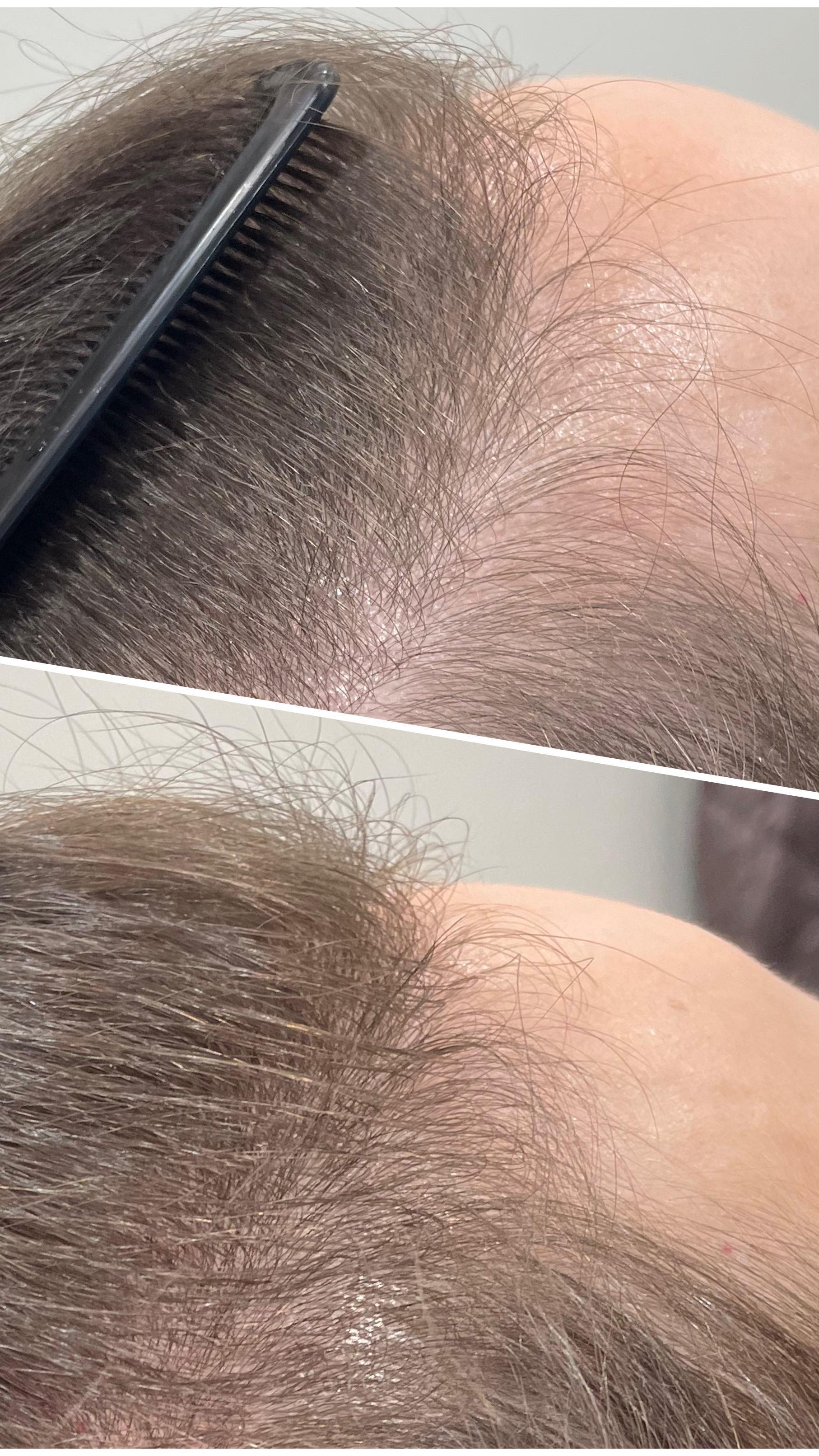 This is insane growth after just 2 hair restoration treatments 😲😍
Treatment takes about 30 minutes and did I mention COMPLETELY PAINLESS. 👏🏻👏🏻👏🏻👏🏻👏🏻
#hairrestoration #hairgrowth #almalasersnorthamerica #almated