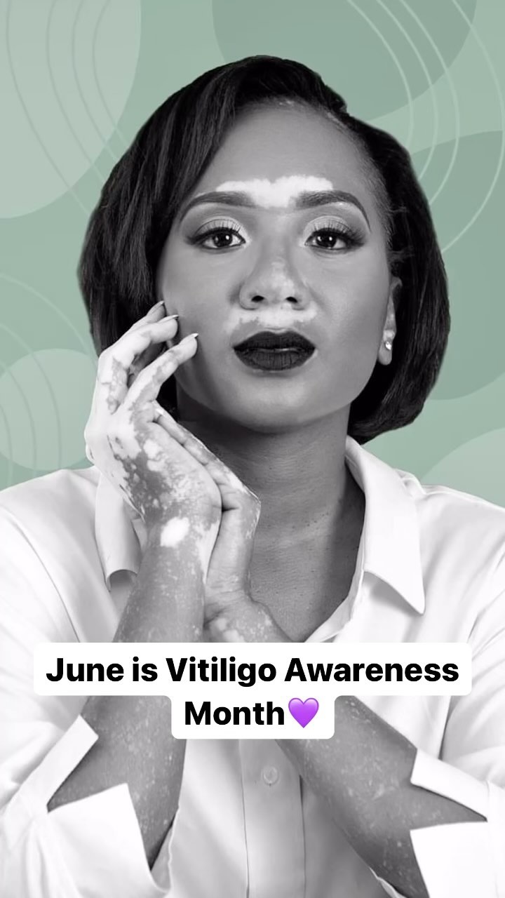 On this #WorldVitiligoDay enjoy this video from our sis, Akenna, as she shares her perspective with vitiligo and some informational insight. 🎥Full video is on her page🎥
.
.
.
.
.
.
.
.
.
.
.
#vitiligo #celebrate #vitifamily #vitiligosupport #vitiligousa #skindifferent #beautifulAsIam #BBfamily #beautifullyblemished