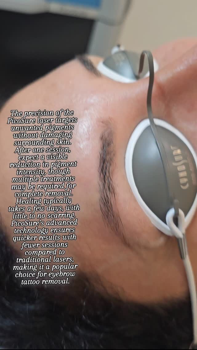 The precision of the PicoSure laser targets unwanted pigments without damaging surrounding skin. After one session, expect a visible reduction in pigment intensity, though multiple treatments may be required for complete removal. Healing typically takes a few days, with little to no scarring. PicoSure’s advanced technology ensures quicker results with fewer sessions compared to traditional lasers, making it a popular choice for eyebrow tattoo removal.
#TattooRemoval
#LaserTattooRemoval
#PicoSureLaser
#CynosurePicoSure
#TattooFading
#ClearSkinJourney
#EraseThePast
#SkinRenewal
#TattooFree
#AdvancedTattooRemoval
#GoodbyeInk
#FadedTattoos
#TattooRegret
#SafeTattooRemoval
#PicoSureResults
#permenantmakeupremoval
#eyebrowstatto
#eyebrowstattoremoval
#windsor
#detroit