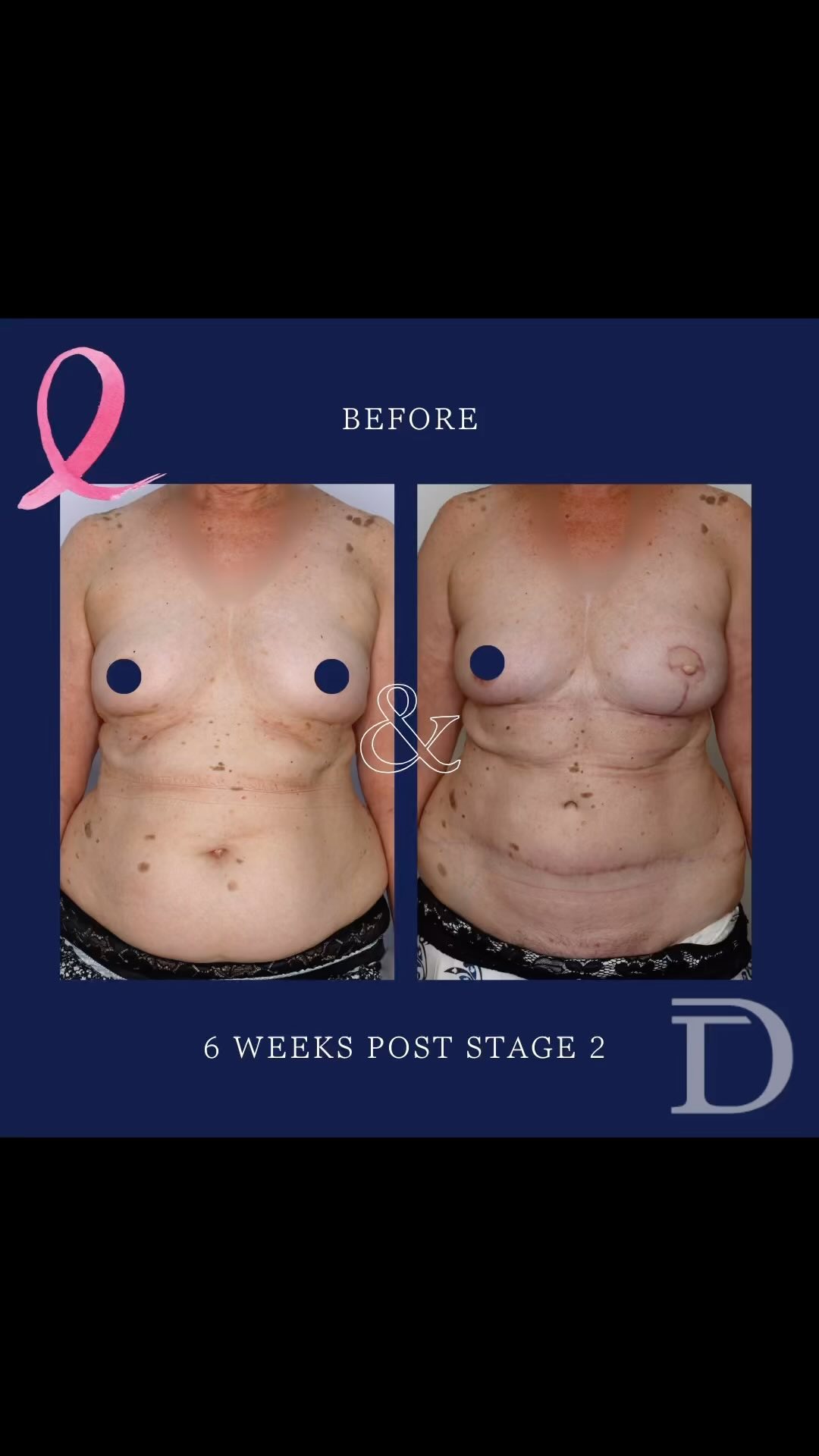 Unilateral Immediate DIEP + Nipple Reconstruction 
1. Pre Op
2. 6 Weeks Post Nipple Reconstruction 
- Mastectomy completed by breast surgeon - immediate DIEP is a combined procedure with both Specialists 
- Nipple reconstruction completed 3-4 months post DIEP surgery
- Areola tattooing to be completed approximately 6 months post nipple reconstruction 
- Scars take 12-18 months to mature/ fade 
Surgery Performed by Dr Duncan Taylor (MED0001883464) Specialist Plastic & Reconstructive Surgeon.
🔹 Outcomes achieved in these photos are only relevant to this patient and do not necessarily reflect the results other patients may experience.
🔹There are inherent risks associated with any surgical or invasive procedures. The recovery period varies based on the specific procedure, and individual outcomes will differ.
🔹More information about risks and recovery for each procedure is available on our website www.drduncantaylor.com.au, on the procedure information sheets.
🔹We recommend getting a second opinion from a qualified health practitioner before proceeding.
🔹 This patient gave photo consent. 
#autologousbreastreconstruction #diepbreastreconstruction #diepsurgery #breastreconstruction #breastreconstructionperth #perthbreastreconstruction #mastectomyperth #perthmastectomy #breastcancerperth #perthbreastcancer #breastcancerwa #perthplasticsurgeon #plasticsurgeonperth #plasticsurgeryperth #perthplasticsurgery #specialistplasticsurgeon #microsurgicalbreastreconstruction