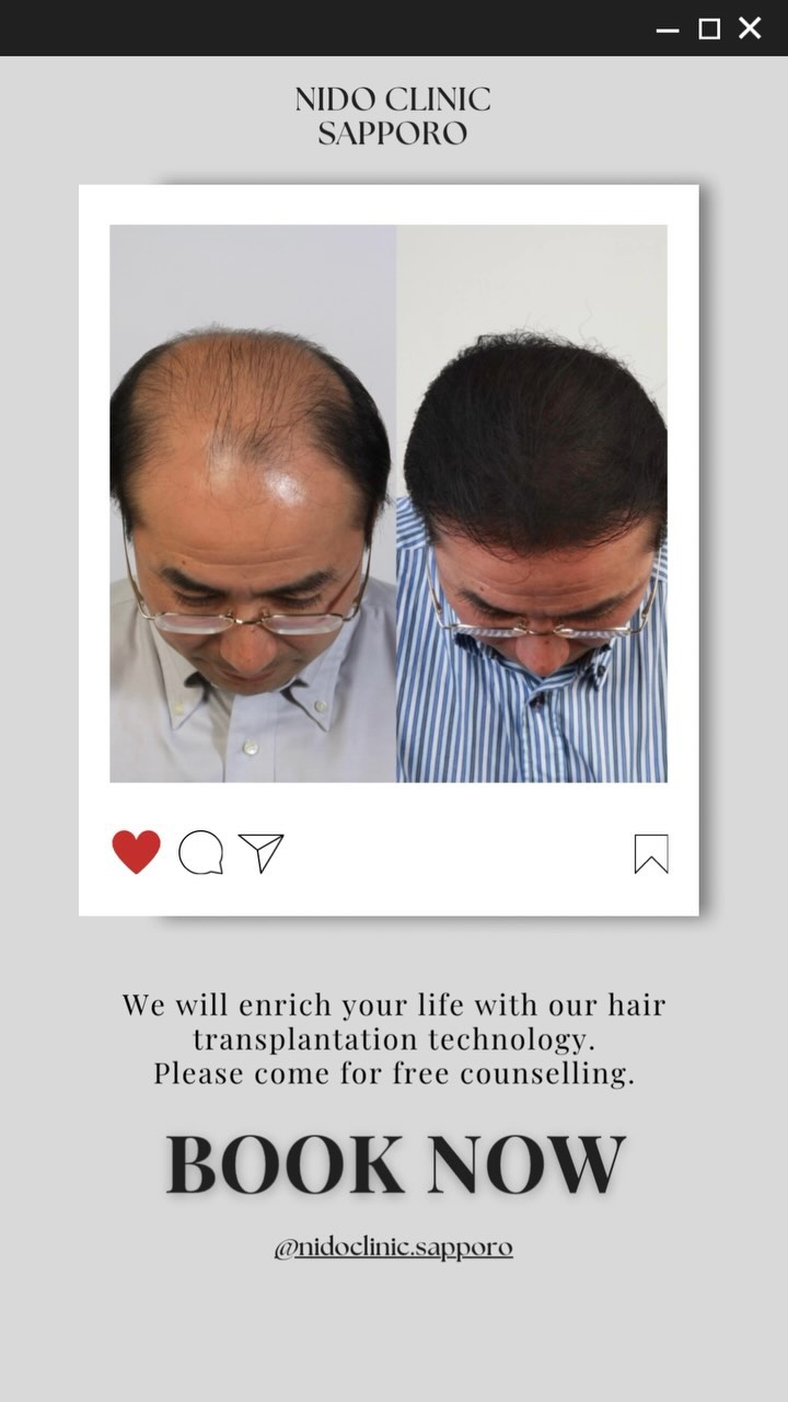 ■施術紹介
💁♂️田代様
施術名:自毛植毛
施術の説明:薄毛になりにくい後頭部・側頭部の毛根をに採取し、前頭部や頭頂部の薄くなった部分に移植する手術です。移植した毛髪は薄毛になりにくい性質を保ったまま定着し、一生涯、生え変わりけます。
施術の副作用(リスク):施術に伴い、痛み、赤み・熱感、初期脱毛、切れ毛・抜け毛、つっぱり感、感覚の鈍さ、施
術範囲のの悪化、コメド、毛嚢炎、膨隆、色素沈着、点状出血、内出血、腫脹、灼熱感、瘢痕が生じることがあります。
施術の価格:360,000円~
•*¨*•.¸¸☆*・゚•*¨*•.¸¸☆*・゚•*¨*•.¸¸☆*・゚•*¨*•.¸¸☆*・゚
他の投稿が見たい方は▼
@nidoclinic.sapporo
ご予約・詳しい詳細はプロフィール欄よりお進みください☺️
•*¨*•.¸¸☆*・゚•*¨*•.¸¸☆*・゚•*¨*•.¸¸☆*・゚•*¨*•.¸¸☆*・゚
AGAは正しい知識をもって治療を行う事が大切です。
まずはお気軽に無料カウンセリングにお越し下さい☺️
良ければ【いいね&(フォロー】をお願いします✨
いつでも見返せるように【保存】もよろしくお願いします🙇♂️
•*¨*•.¸¸☆*・゚•*¨*•.¸¸☆*・゚•*¨*•.¸¸☆*・゚•*¨*•.¸¸☆*・゚
ニドークリニック札幌
◼️所在地
📍北海道札幌市中央区南1条西6丁目11番 札幌北辰ビル7階
◼️営業時間
⏰9:30~18:00(受付17:00まで)
🗓️定休日:木曜、第1・3日曜、他隔週月曜
◼️お電話でお問い合わせの際は「Instagramを見た」と仰っていただけるとスムーズです。
📞011-281-0210
•*¨*•.¸¸☆*・゚•*¨*•.¸¸☆*・゚•*¨*•.¸¸☆*・゚•*¨*•.¸¸☆*・゚
#ニドークリニック札幌 #ニドークリニック #植毛 #自毛植毛 #植毛手術 #薄毛治療 #薄毛改善 #薄毛対策 #薄毛が悩み #薄毛 #aga #aga治療 #aga治療薬 #北海道 #札幌 #札幌駅 #大通り#薄毛女子 #女性の薄毛治療 #ハゲ対策 #ハゲ改善 #植毛札幌 #植毛職人 #植毛名医