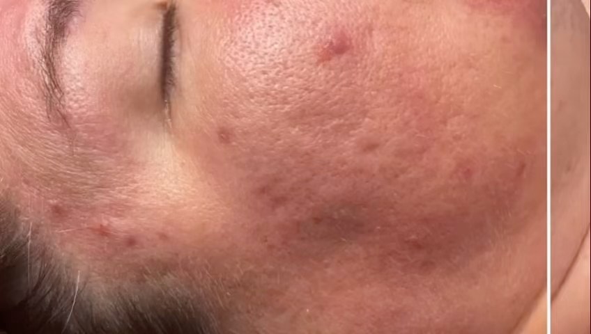 Dermalux offers unique regenerative and recovery benefits and enables more successful results with inflammatory conditions. Results after 2 treatments