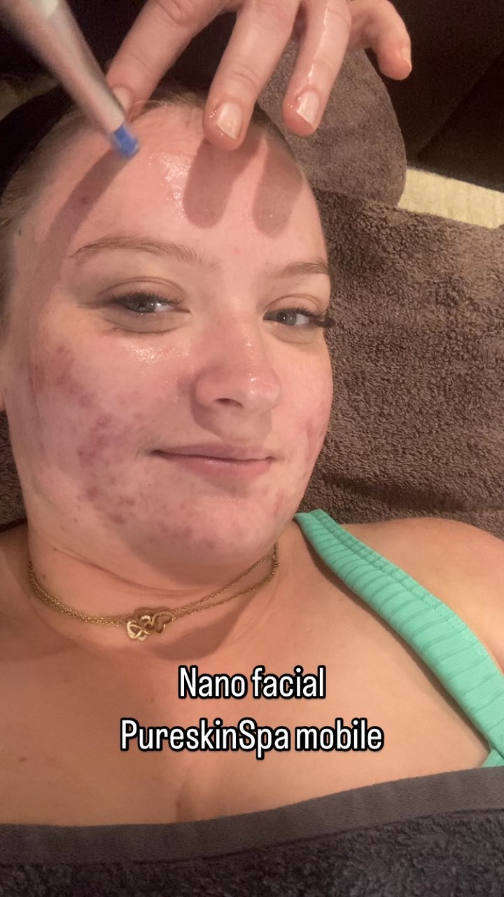 Nano Rezernate facial, a non-invasive anti-aging treatment that utilises nanotechnology to create thousands of micro permeations on the skin for deeper product penetration.
Cold therapy and an anti-aging mask to complete the hydrating, de puffy the face.
Love your skin
Younger longer
#sunshinecoast #maryvalley #gympie #noosa #cooroy #eumundi #eumundi #mobilebeauty #noosaville #pureskinspamobile #plasma #plasmafibroblast #youngerlonger