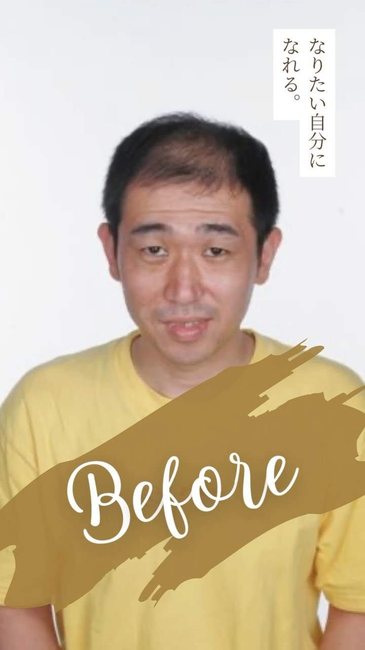 ■施術紹介
💁♂️五十川様
施術名:自毛植毛
施術の説明:薄毛になりにくい後頭部・側頭部の毛根をに採取し、前頭部や頭頂部の薄くなった部分に移植する手術です。移植した毛髪は薄毛になりにくい性質を保ったまま定着し、一生涯、生え変わりけます。
施術の副作用(リスク):施術に伴い、痛み、赤み・熱感、初期脱毛、切れ毛・抜け毛、つっぱり感、感覚の鈍さ、施
術範囲のの悪化、コメド、毛嚢炎、膨隆、色素沈着、点状出血、内出血、腫脹、灼熱感、瘢痕が生じることがあります。
施術の価格:360,000円~
•*¨*•.¸¸☆*・゚•*¨*•.¸¸☆*・゚•*¨*•.¸¸☆*・゚•*¨*•.¸¸☆*・゚
他の投稿が見たい方は▼
@nidoclinic.sapporo
ご予約・詳しい詳細はプロフィール欄よりお進みください☺️
•*¨*•.¸¸☆*・゚•*¨*•.¸¸☆*・゚•*¨*•.¸¸☆*・゚•*¨*•.¸¸☆*・゚
AGAは正しい知識をもって治療を行う事が大切です。
まずはお気軽に無料カウンセリングにお越し下さい☺️
良ければ【いいね&(フォロー】をお願いします✨
いつでも見返せるように【保存】もよろしくお願いします🙇♂️
•*¨*•.¸¸☆*・゚•*¨*•.¸¸☆*・゚•*¨*•.¸¸☆*・゚•*¨*•.¸¸☆*・゚
ニドークリニック札幌
◼️所在地
📍北海道札幌市中央区南1条西6丁目11番 札幌北辰ビル7階
◼️営業時間
⏰9:30~18:00(受付17:00まで)
🗓️定休日:木曜、第1・3日曜、他隔週月曜
◼️お電話でお問い合わせの際は「Instagramを見た」と仰っていただけるとスムーズです。
📞011-281-0210
•*¨*•.¸¸☆*・゚•*¨*•.¸¸☆*・゚•*¨*•.¸¸☆*・゚•*¨*•.¸¸☆*・゚
#ニドークリニック札幌 #ニドークリニック #植毛 #自毛植毛 #植毛手術 #薄毛治療 #薄毛改善 #薄毛対策 #薄毛が悩み #薄毛 #aga #aga治療 #aga治療薬 #北海道 #札幌 #札幌駅 #大通り#薄毛女子 #女性の薄毛治療 #ハゲ対策 #ハゲ改善 #植毛札幌 #植毛職人 #植毛名医