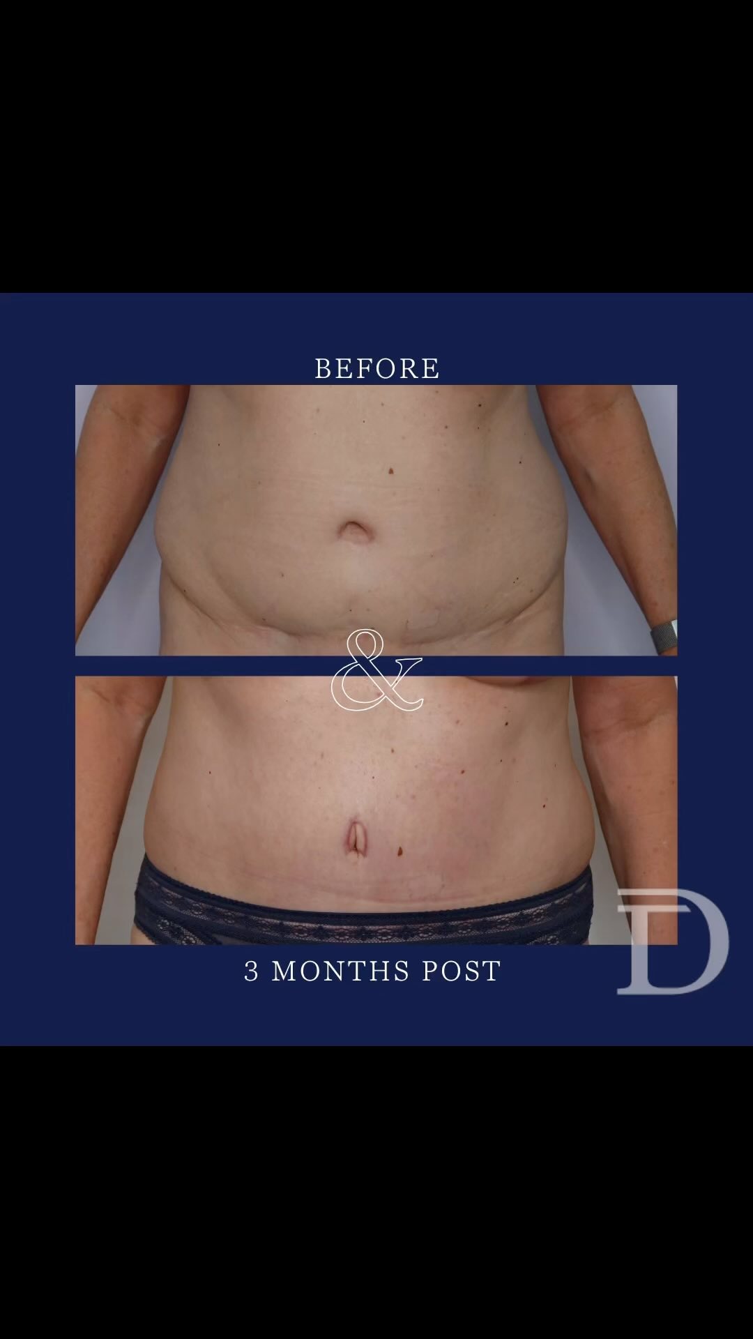 Revision Abdominoplasty +  Liposuction
1. Pre Op
2. 3 Months Post 
- Initial abdominoplasty procedure completed 30 years ago by another Surgeon 
- Scars take 12-18 months to mature/ fade 
Surgery Performed by Dr Duncan Taylor (MED0001883464) Specialist Plastic & Reconstructive Surgeon.
🔹 Outcomes achieved in these photos are only relevant to this patient and do not necessarily reflect the results other patients may experience.
🔹There are inherent risks associated with any surgical or invasive procedures. The recovery period varies based on the specific procedure, and individual outcomes will differ.
🔹More information about risks and recovery for each procedure is available on our website www.drduncantaylor.com.au, on the procedure information sheets.
🔹We recommend getting a second opinion from a qualified health practitioner before proceeding.
🔹 This patient gave photo consent. 
#revisionabdominoplasty #redoabdominoplasty #abdominoplastyperth #perthabdominoplasty #tummytuckperth #perthtummytuck #bodycontouringperth #perthbodycontouring #cosmeticsurgeryperth #perthcosmeticsurgeon #plasticsurgeryperth #perthplasticsurgery #specialistplasticsurgeon