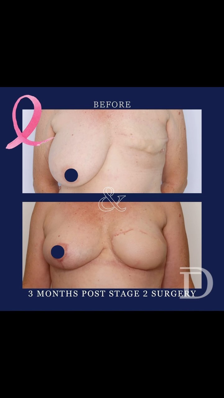 Left Delayed DIEP Breast Reconstruction 
1. Pre Op
2. 3 Months Post 2nd Stage Revision Surgery 
- Surgery to create symmetry (ie. contralateral breast reduction/ lift) is completed during a 2nd procedure 3-4 months post initial DIEP surgery 
- Scars take 12-18 months to mature/ fade 
Surgery Performed by Dr Duncan Taylor (MED0001883464) Specialist Plastic & Reconstructive Surgeon.
🔹 Outcomes achieved in these photos are only relevant to this patient and do not necessarily reflect the results other patients may experience.
🔹There are inherent risks associated with any surgical or invasive procedures. The recovery period varies based on the specific procedure, and individual outcomes will differ.
🔹More information about risks and recovery for each procedure is available on our website www.drduncantaylor.com.au, on the procedure information sheets.
🔹We recommend getting a second opinion from a qualified health practitioner before proceeding.
🔹 This patient gave photo consent. 
 #unilateraldiepflap #diepbreastreconstruction #autologousbreastereconstruction #breastreconstructionawareness #breastreconstructionperth #perthbreastreconstruction #breastcancerperth #perthbreastcancer #breastcancerwa #perthplasticsurgeon #perthplasticsurgery #plasticsurgeryperth #specialistplasticsurgeon #unilateralmastectomy #owntissuereconstruction