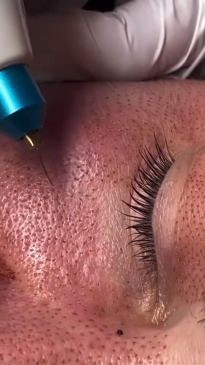Plasma Fibroblast season
50% off
❤️want to shrink your loose skin?
Soften wrinkles?
Younger longer
#sunshinecoast #maryvalley #gympie #noosa #eumundi #youngerlonger #imbil #mobilebeauty #noosaville #pureskinspamobile #doonan #peregianbeach