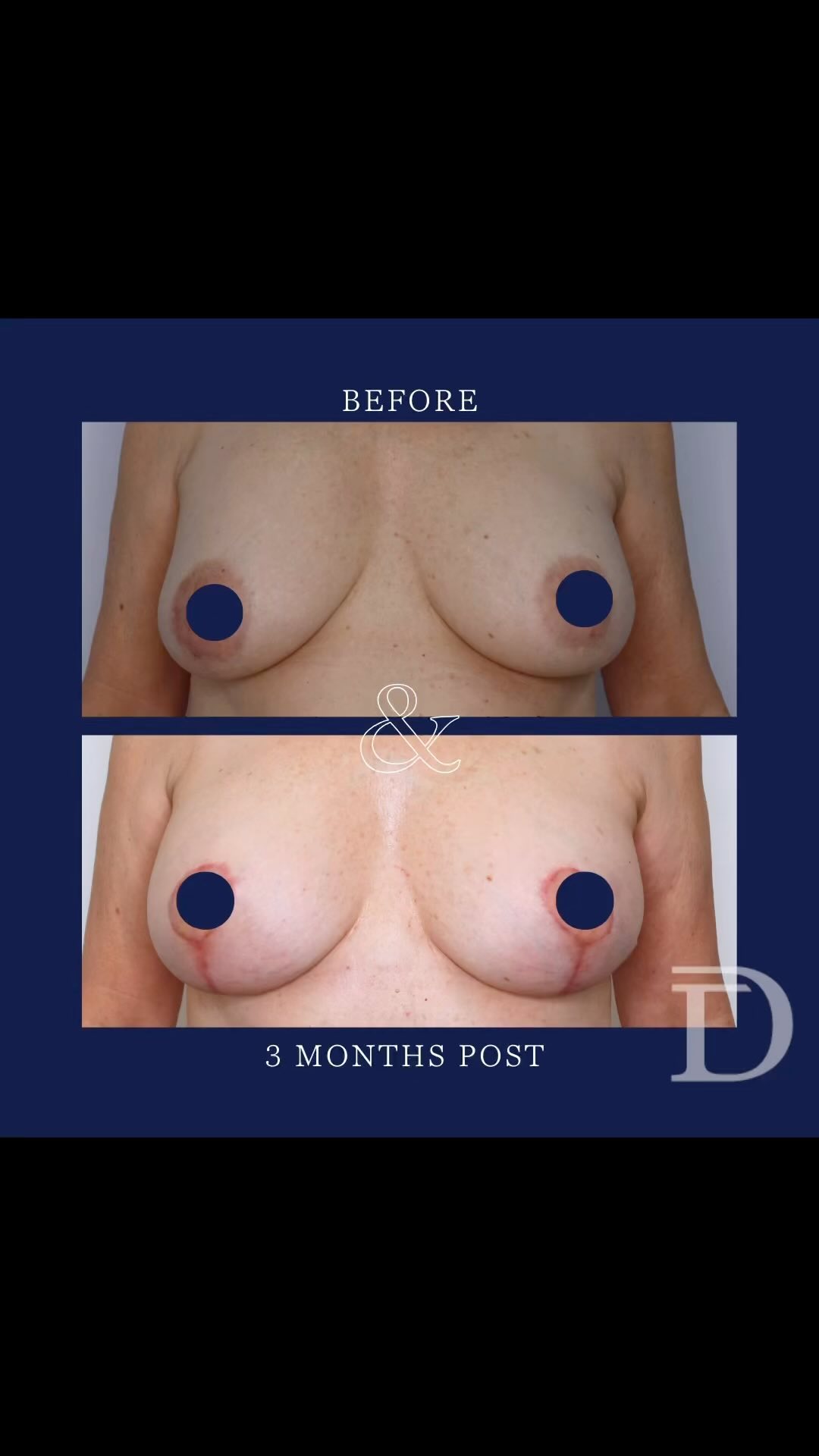 Replacement of Breast Implants + Mastopexy (Breast Lift) + Fat Grafting
1. Pre Op
2. 3 Months Post 
- Scars take 12-18 months to mature/ fade 
Surgery Performed by Dr Duncan Taylor (MED0001883464) Specialist Plastic & Reconstructive Surgeon.
🔹 Outcomes achieved in these photos are only relevant to this patient and do not necessarily reflect the results other patients may experience.
🔹There are inherent risks associated with any surgical or invasive procedures. The recovery period varies based on the specific procedure, and individual outcomes will differ.
🔹More information about risks and recovery for each procedure is available on our website www.drduncantaylor.com.au, on the procedure information sheets.
🔹We recommend getting a second opinion from a qualified health practitioner before proceeding.
🔹 This patient gave photo consent. 
#plasticsurgeryperth #perthplasticsurgery #plasticsurgeonperth #plasticsurgeonperth #cosmeticsurgeryperth #perthbreastaugmentation #breastaugmentationperth #specialistplasticsurgeon #breastimplantsperth #perthbreastimplants #breastliftperth #perthbreastlift #fatgraftingperth