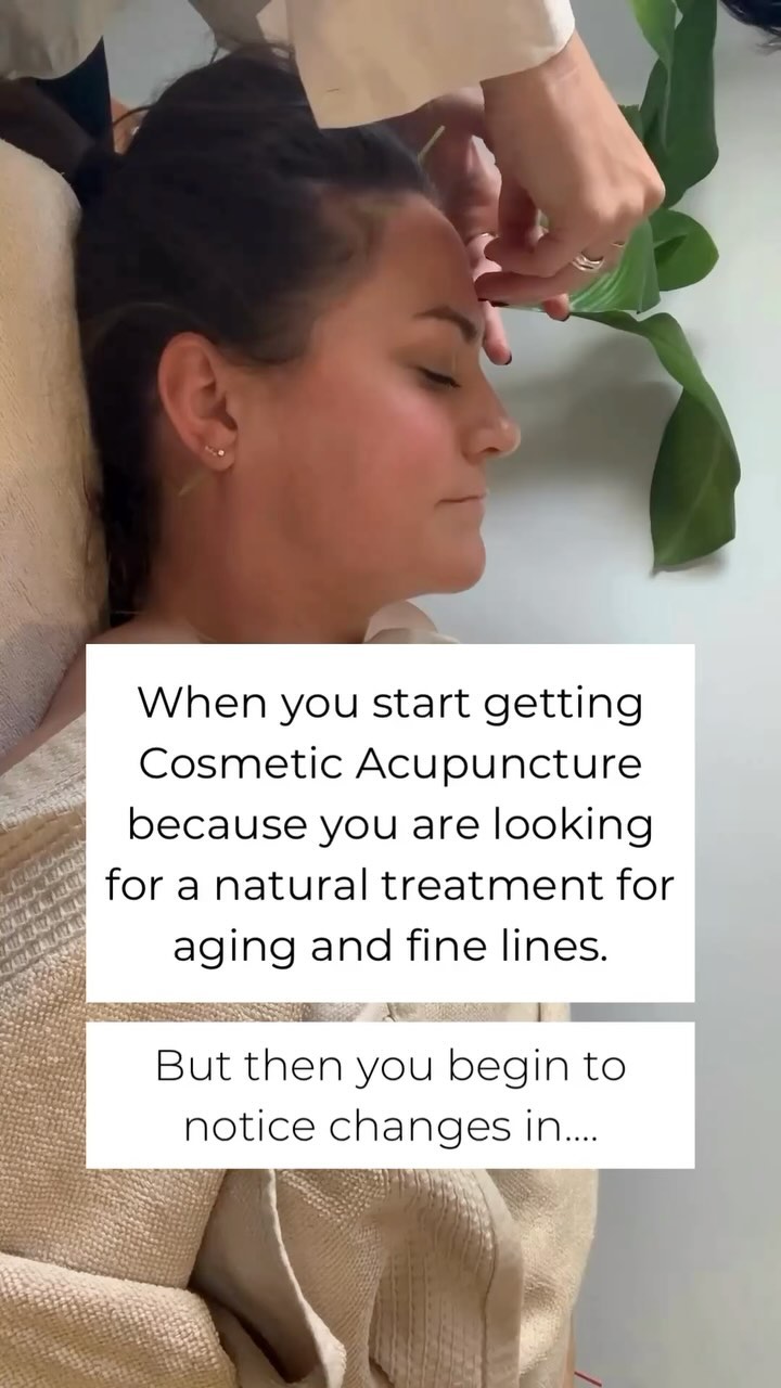 Here’s why when you start doing Cosmetic Acupuncture (because you are looking for a natural treatment for aging and fine lines) you start to notice changes in:
✔️Moisture and hydration
✔️Skin texture and tone
✔️Less hormonal breakouts
✔️A shift in energy levels, digestion and general wellbeing
Whilst the focus is on the face, the treatment is not complete without body acupuncture points that balance your internal health.
This is done by stimulating the relevant meridians, and tapping into your endocrine system, immune system and nervous system.
Cosmetic Acupuncture sessions (which include LED Light Therapy) are available in Middle Park Melbourne.
🍃A series of treatments recommended
🍃Packages for multiple sessions are also available.
Lets get glowy from the inside out with Cosmetic Acupuncture!
Comment skin and I’ll send you more info or links for booking in bio.
-----
Glow Acupuncture & Chinese Medicine 106 Canterbury Rd, Middle Park VIC 3206
.
.
.
.
.
.
#cosmeticacupuncturemelbourne #facialacupuncture #melbourne #cosmeticacupuncture #wrinkles #finelines #acupuncture #holistichealth #glowacpuncture #ageing #healthyskin #innerhealthouterglow