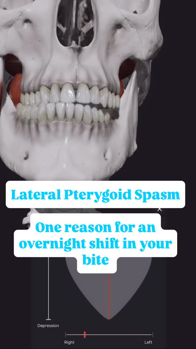 Ever feel like your bite is off—like your teeth suddenly don’t line up the same? Has your dentist cleared this as being a purely dental or orthodontic issue?
It could be a spasm in your lateral pterygoid muscle, not a problem with your teeth. This small but mighty muscle can pull your jaw to one side, creating a sudden lateral shift in your bite that can feel alarming.
The good news?
This isn’t something you need braces or orthodontics for. In many cases, dry needling to the lateral pterygoid can bring immediate relief, restoring your normal bite alignment and easing tension.
If your jaw feels off, don’t panic—physio might be the answer.
📍Book a your initial evaluation through www.headwayphysio.com
#TMJPhysio #JawPainRelief #LateralPterygoid #TMJD #DryNeedling #TorontoPhysio #BiteAlignment #TMDPhysiotherapy #HeadwayPhysio #PhysioForTMJ #CraniofacialPain #TMJSpecialist #TMJRelief #BiteShift #FacialPain #temporomandibularjoint