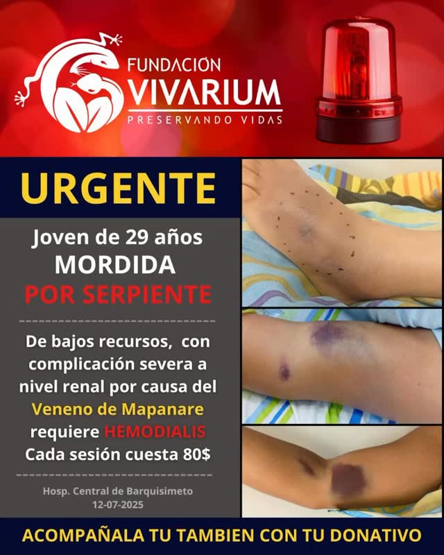 🆘 Ayuda urgente para paciente con complicaciones graves tras mordedura de mapanare en Lara
Una joven víctima de mordedura de serpiente (Bothrops) presenta equimosis extensas, sangrado subcutáneo y falla renal aguda. Actualmente está en hemodiálisis y necesita apoyo urgente para cubrir hemodiálisis, tratamiento y nuevos exámenes de laboratorio.
Desde Fundación Vivarium brindamos acompañamiento médico, logístico y emocional. Este caso refleja la gravedad de los envenenamientos cuando no se neutralizan completamente.
🙏 Tu apoyo puede salvarle la vida.
Dona, comparte, involúcrate.
#EmergenciaOfídica #FundaciónVivarium #DonarSalvaVidas #AccidenteOfídico #SaludVenezuela #SueroAntiofídico