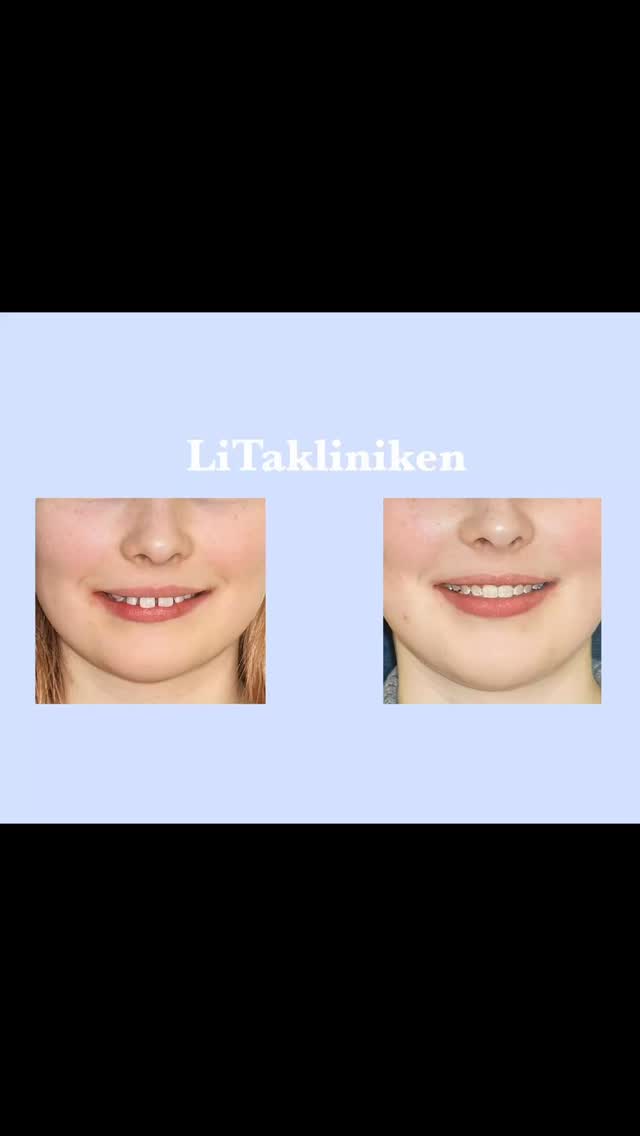 ⭐️ Multidisciplinärt samarbete ⭐️
Tonårig patient, sen i tandväxlingen, med postnormalt, djupt bett, stor horisontell överbitning (9 mm), gingival påbitning, läppdysfunktion, frenulum anomale samt agenesi 35 och underutvecklat/ektopiskt anlag 45 och dessutom glesställning, inkl. diastema mediale❗️
BEHANDLING - Specialisttandvård x2
Behandlingsplanering:
Specialisttandläkare i ortodonti, Med. Dr. Jari Taghavi
👉 Utförande:
Barntandvården Pedodontikliniken @folktandvarden_uppsala_lan
✅ Frenulektomi av centralt läppband
✅ Kirurgiskt avlägsnande av underutvecklat och ektopiskt tandanlag (45)
Specialisttandvården/Ortodonti
@litakliniken
✅ Tandreglering med fastsittande tandställning enligt VAST klass II protokoll
✅ Cannon Ultra Brackets
👉 Resultat:
Klass I ocklusion med normaliserad horisontell överbitning (3,5 mm) samt normaliserad vertikal överbitning, harmonisk ocklusion, gott läppslut
👉 Beräknad behandlingstid: 2,5-3 år
👉 Faktisk/aktiv behandlingstid: 2 år
Vi tackar kollegorna på FTV Pedodontikliniken och vår fantastiska patient för ett mycket gott samarbete 🙏🤗
⭐️⭐️⭐️⭐️⭐️
#orthodontic #magic #uppsala