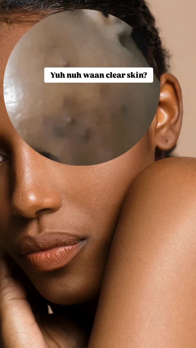 Den weh yaah weit pon?
Di Clear Skin Serum get rid a acne spots an clear up yuh skin.
Yuh nuh beleev mi? Try it an si.
#foryouskinbar #jamaicanskincare #clearskinjourney #melaninskincare #darkspotcorrector #acnetreatment #clearskinja #clearskinserum